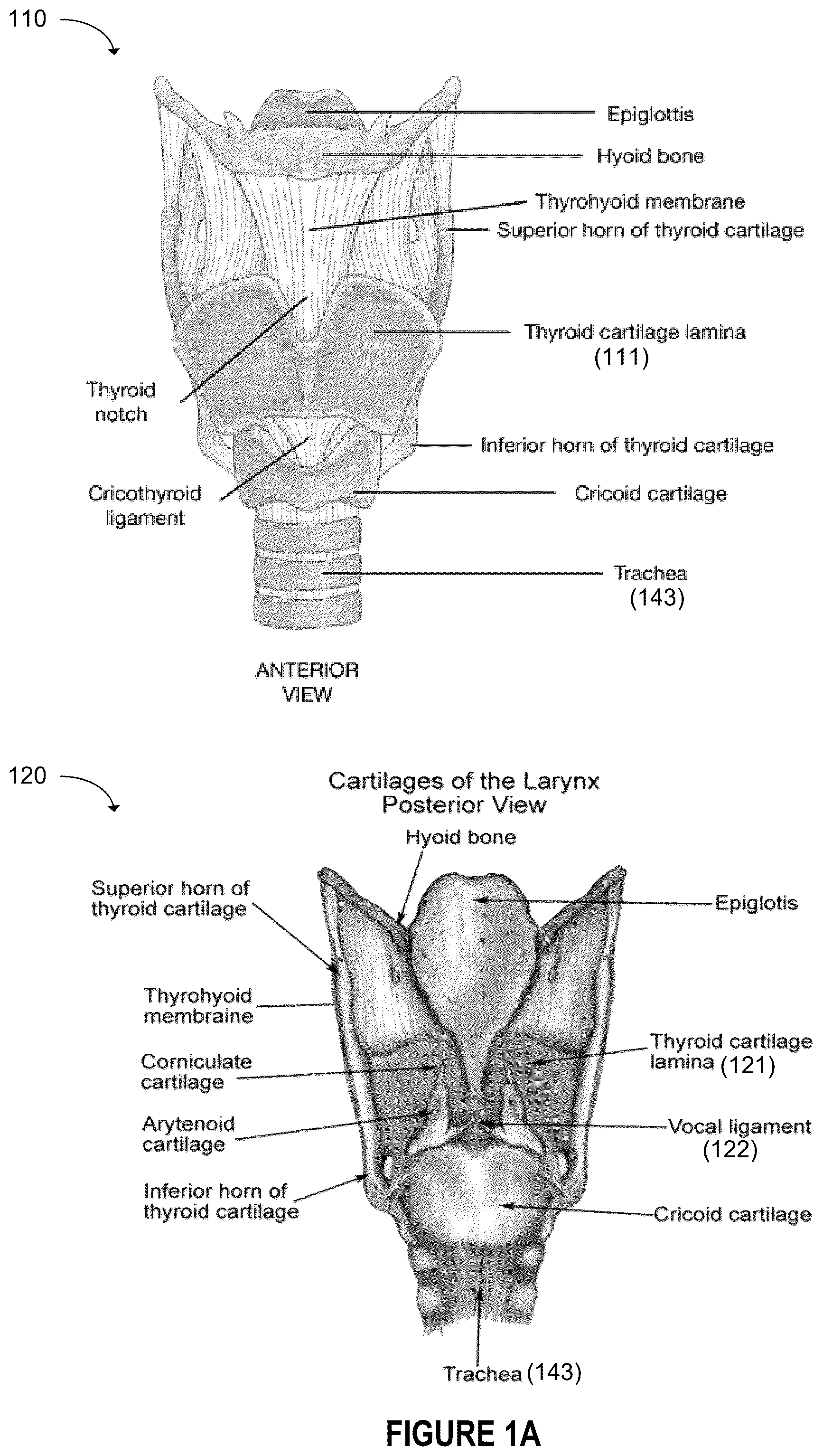 Patent US12396844 Figure 1 – Methods and apparatus for treating glottic insufficiency