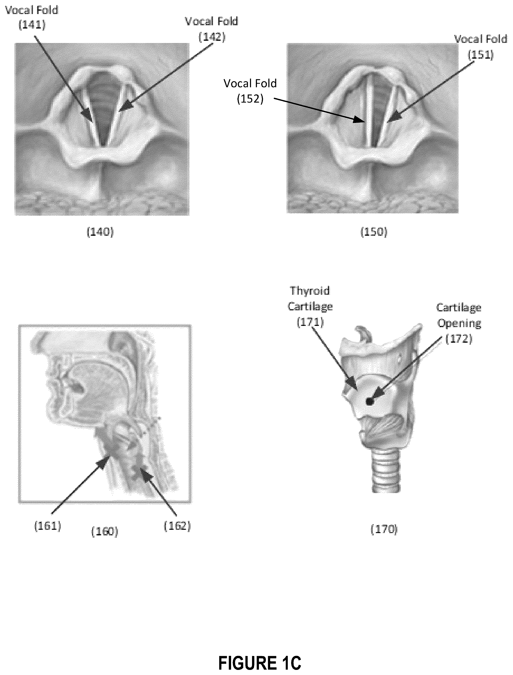 Patent US12396844 Figure 3 – Methods and apparatus for treating glottic insufficiency