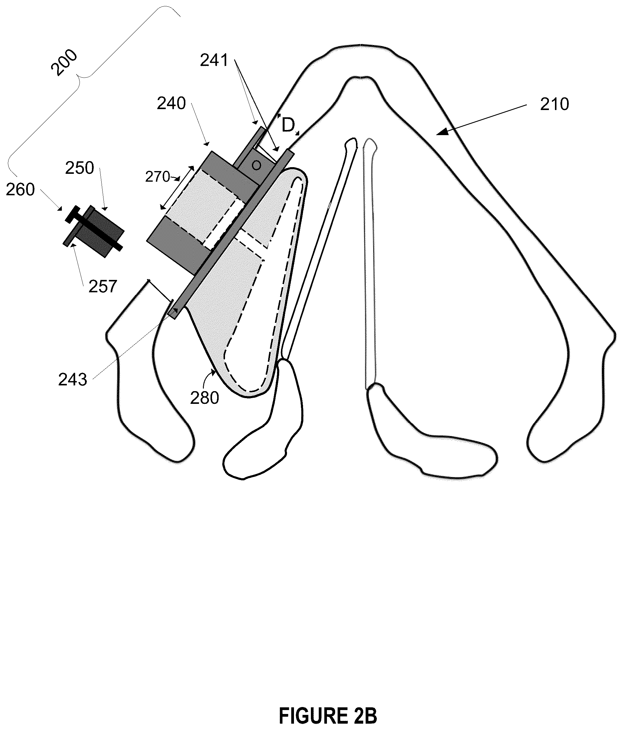 Patent US12396844 Figure 5 – Methods and apparatus for treating glottic insufficiency