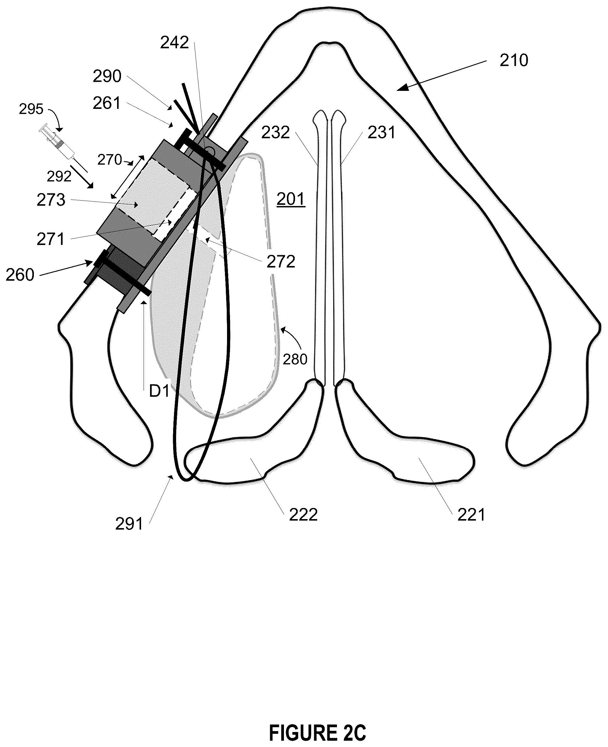 Patent US12396844 Figure 6 – Methods and apparatus for treating glottic insufficiency