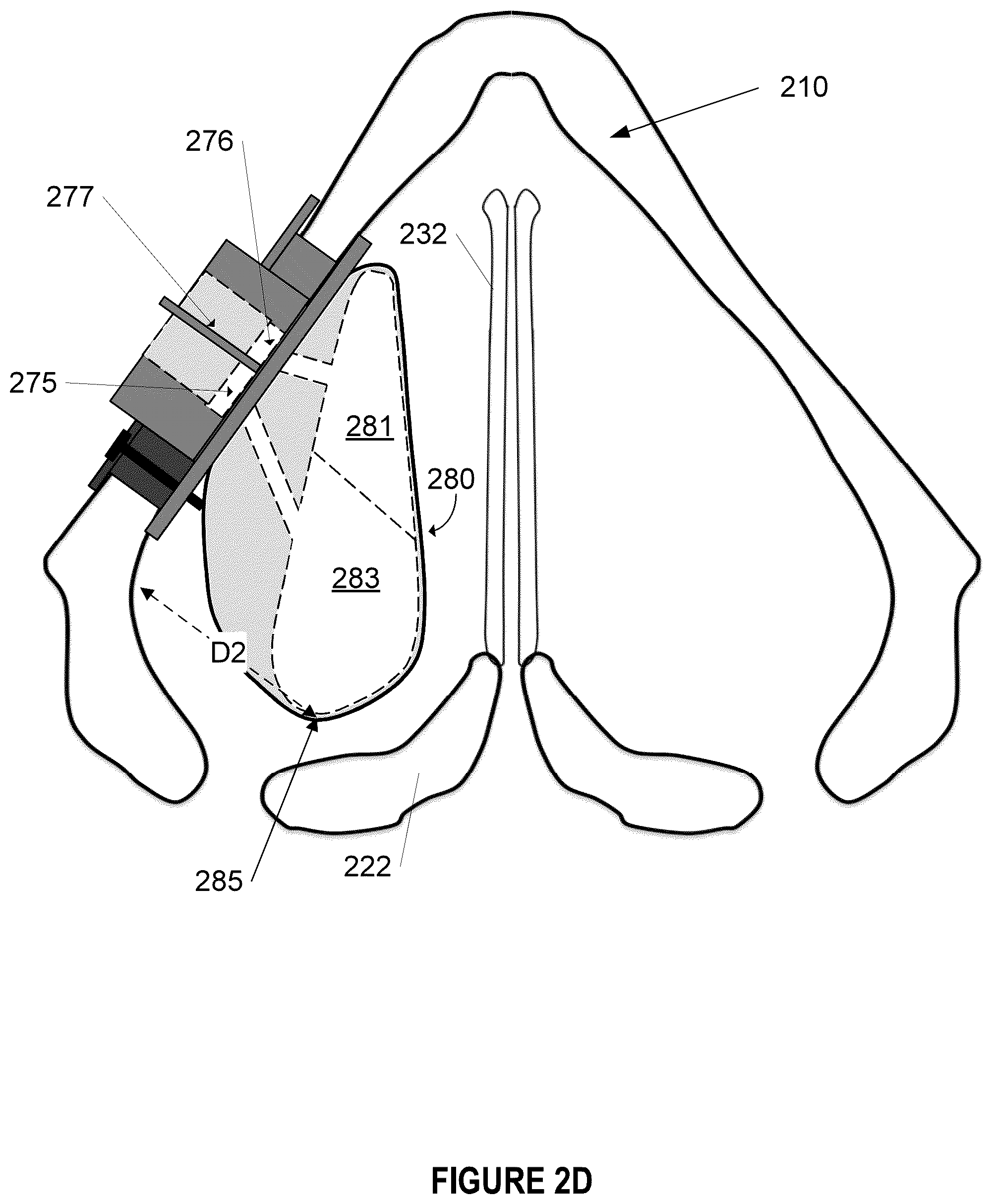 Patent US12396844 Figure 7 – Methods and apparatus for treating glottic insufficiency