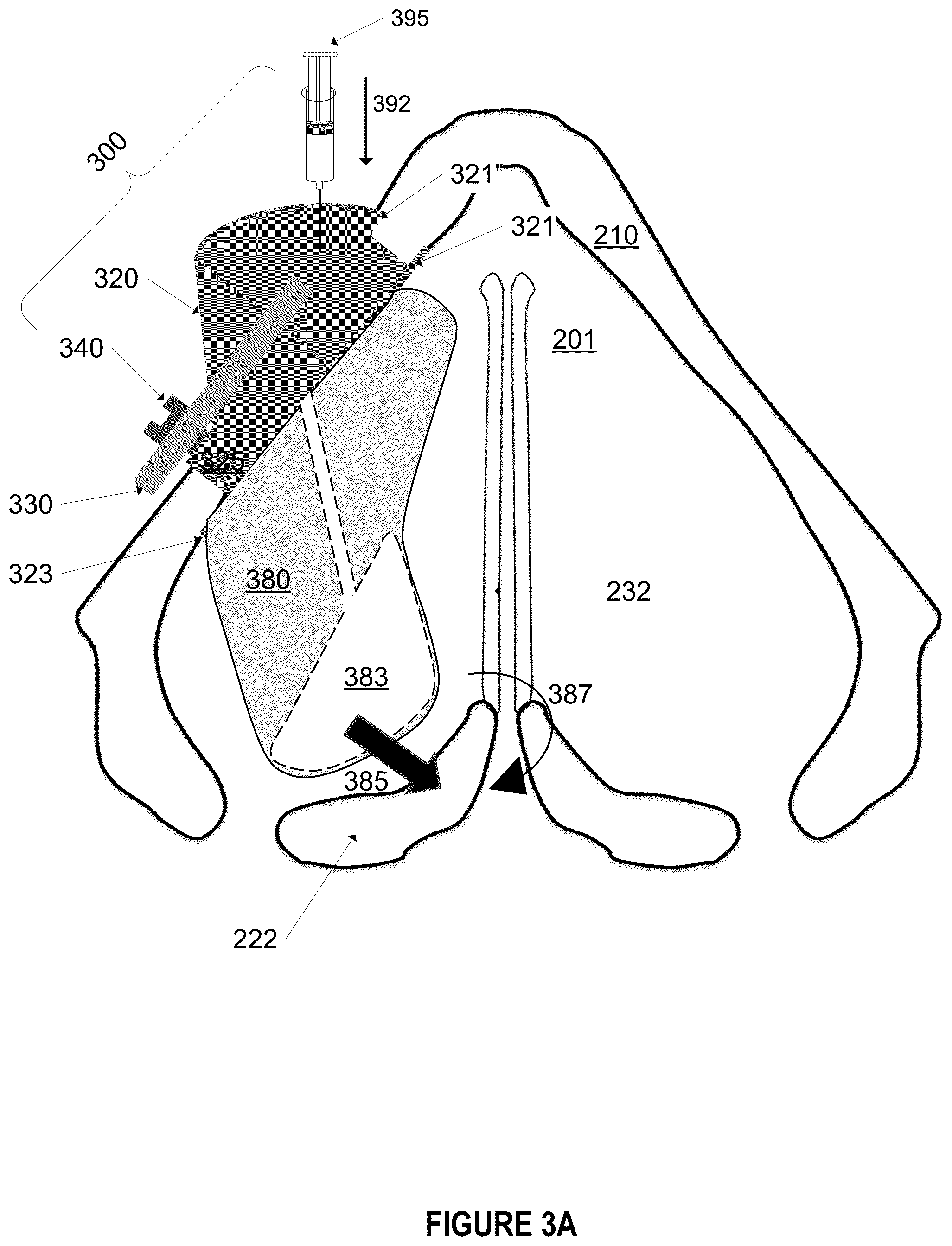 Patent US12396844 Figure 9 – Methods and apparatus for treating glottic insufficiency