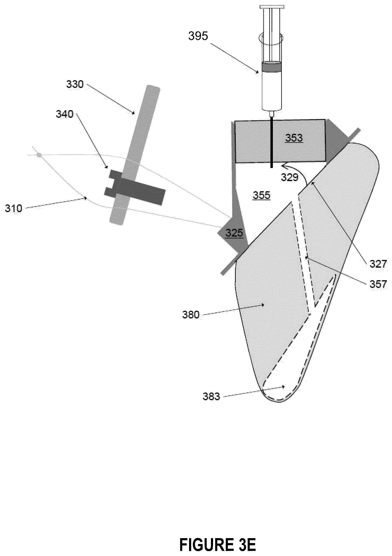 Patent US12396844 Figure 13 – Methods and apparatus for treating glottic insufficiency