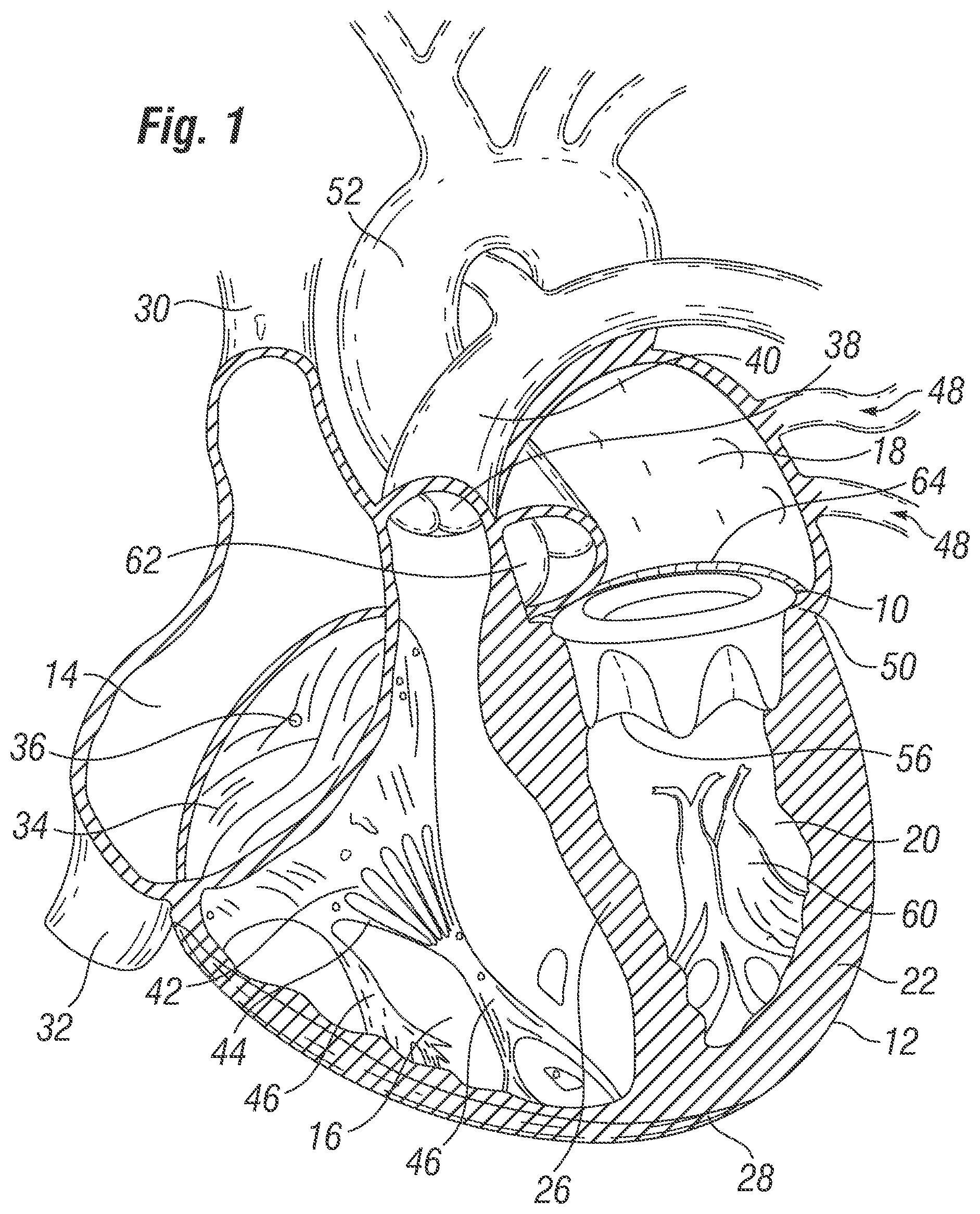 Patent US12396846 — Methods of implanting a prosthetic heart valve within another — Figure 1