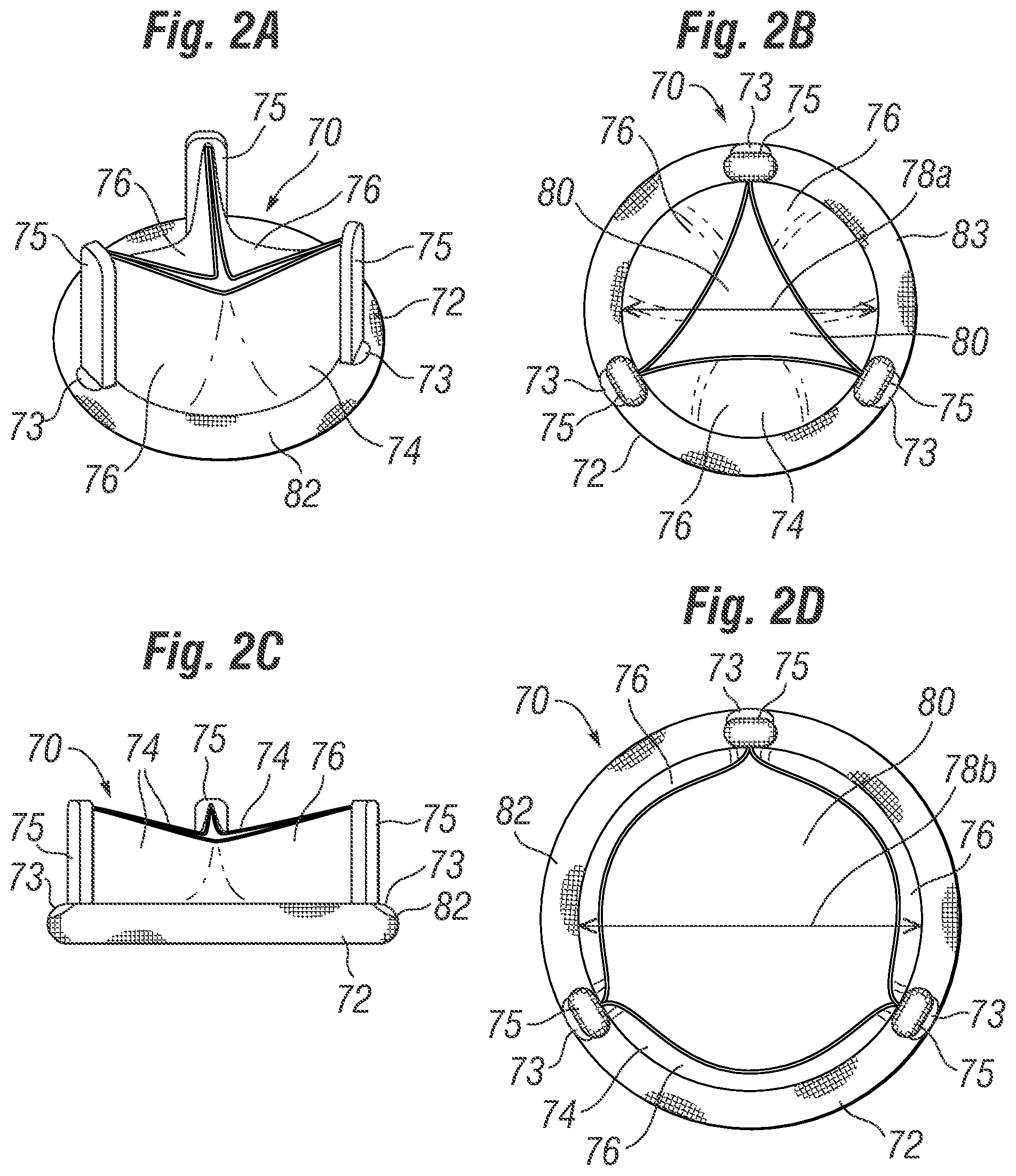 Patent US12396846 Figure 2 – Methods of implanting a prosthetic heart valve within another