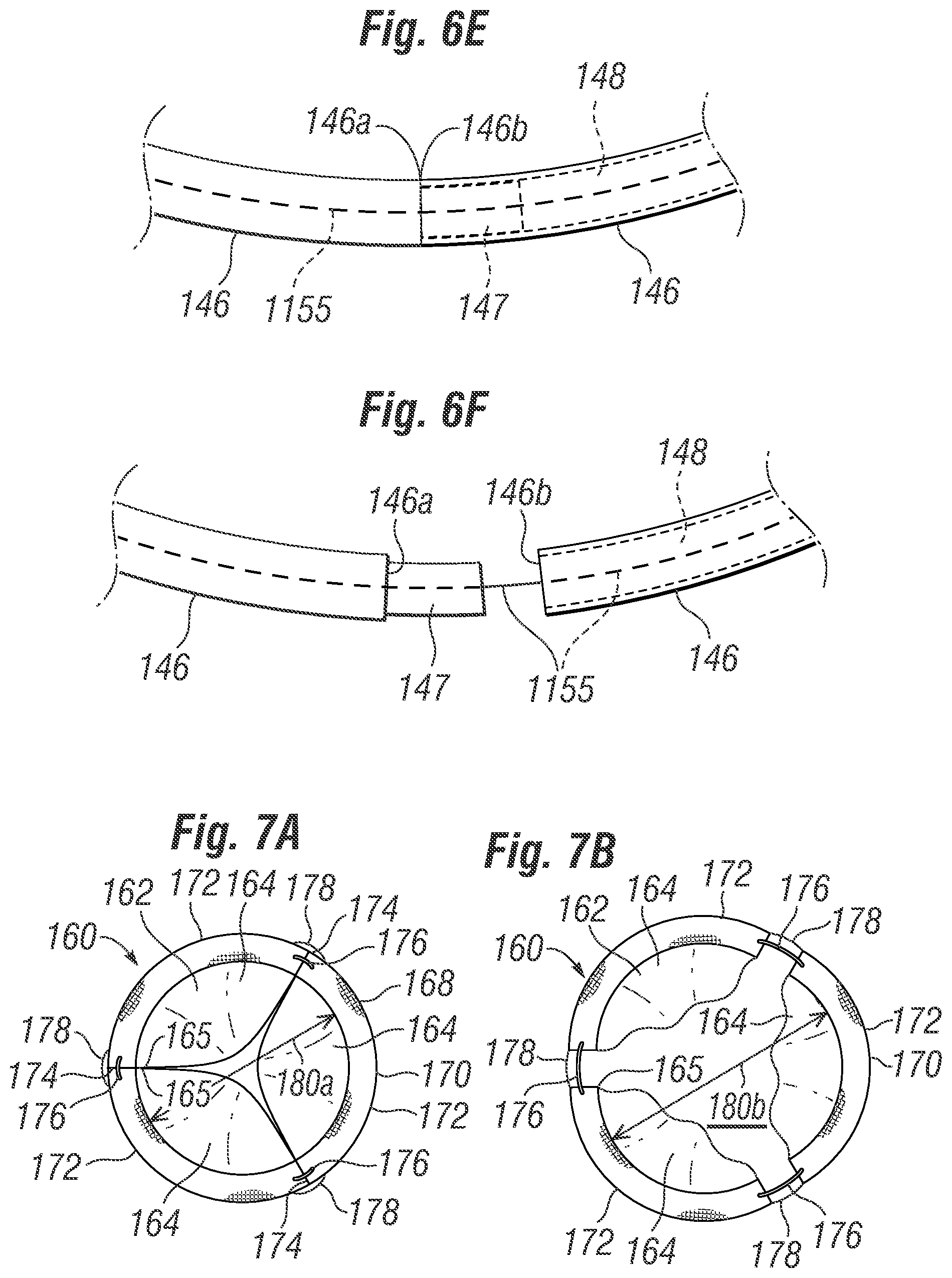 Patent US12396846 Figure 6 – Methods of implanting a prosthetic heart valve within another