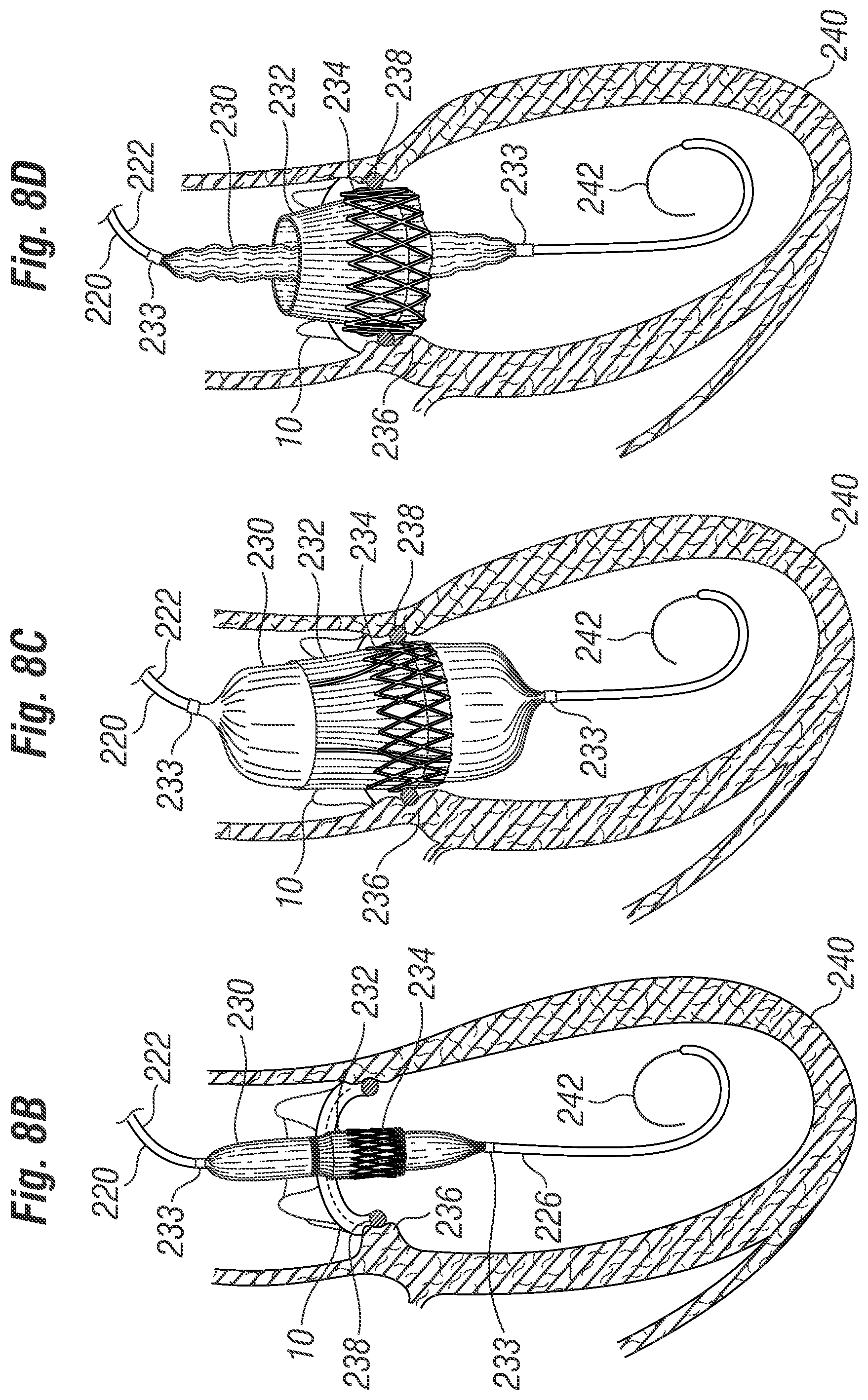 Patent US12396846 Figure 8 – Methods of implanting a prosthetic heart valve within another