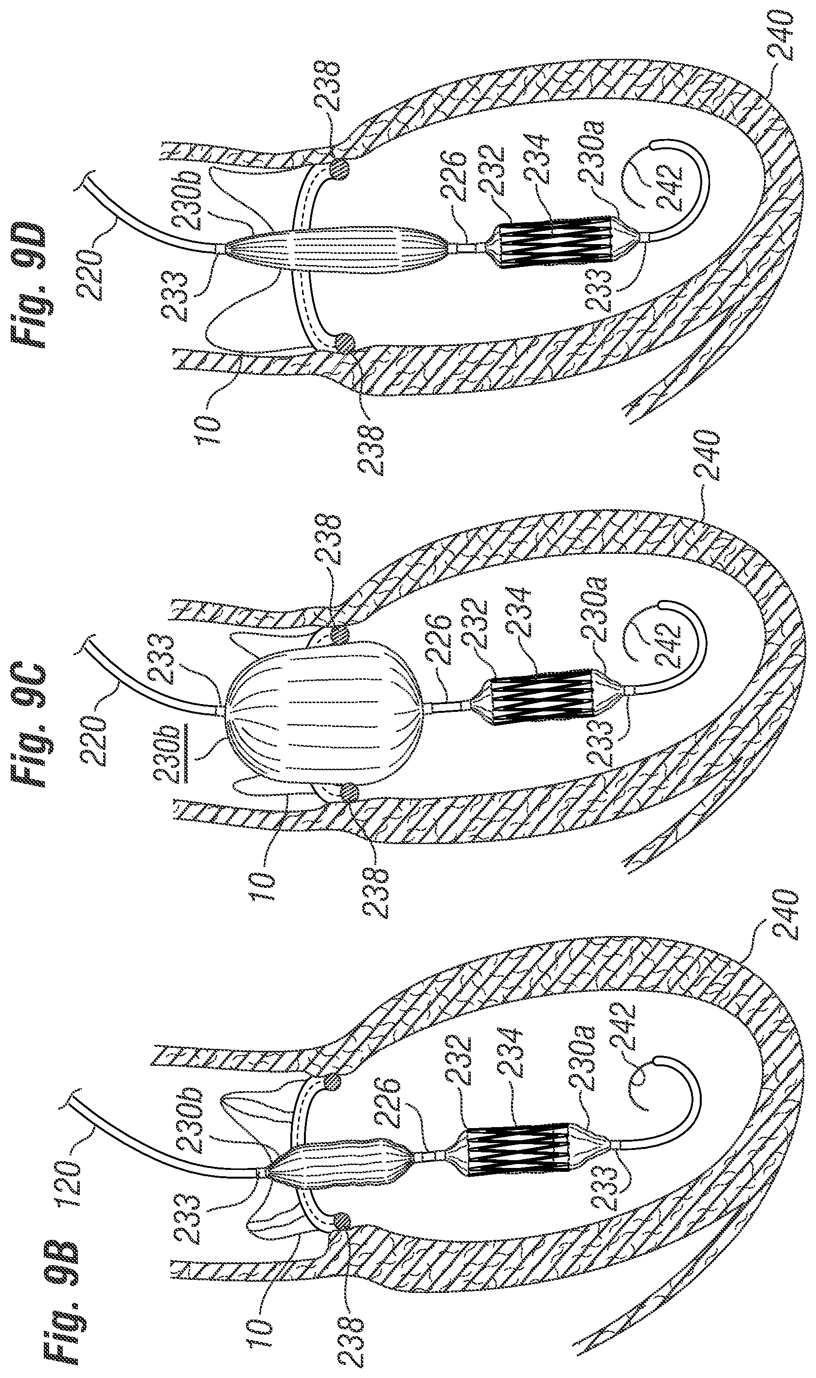 Patent US12396846 Figure 9 – Methods of implanting a prosthetic heart valve within another