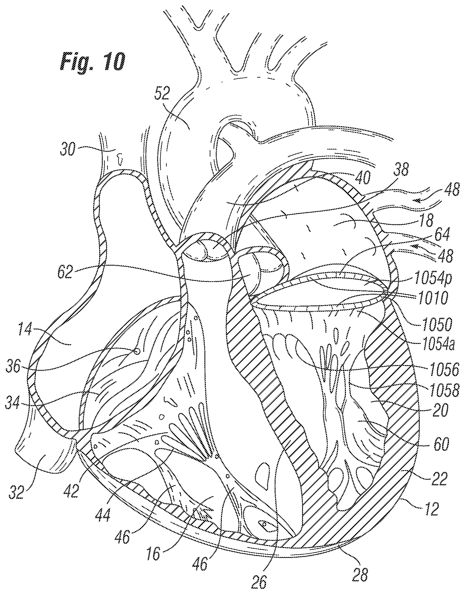 Patent US12396846 Figure 10 – Methods of implanting a prosthetic heart valve within another