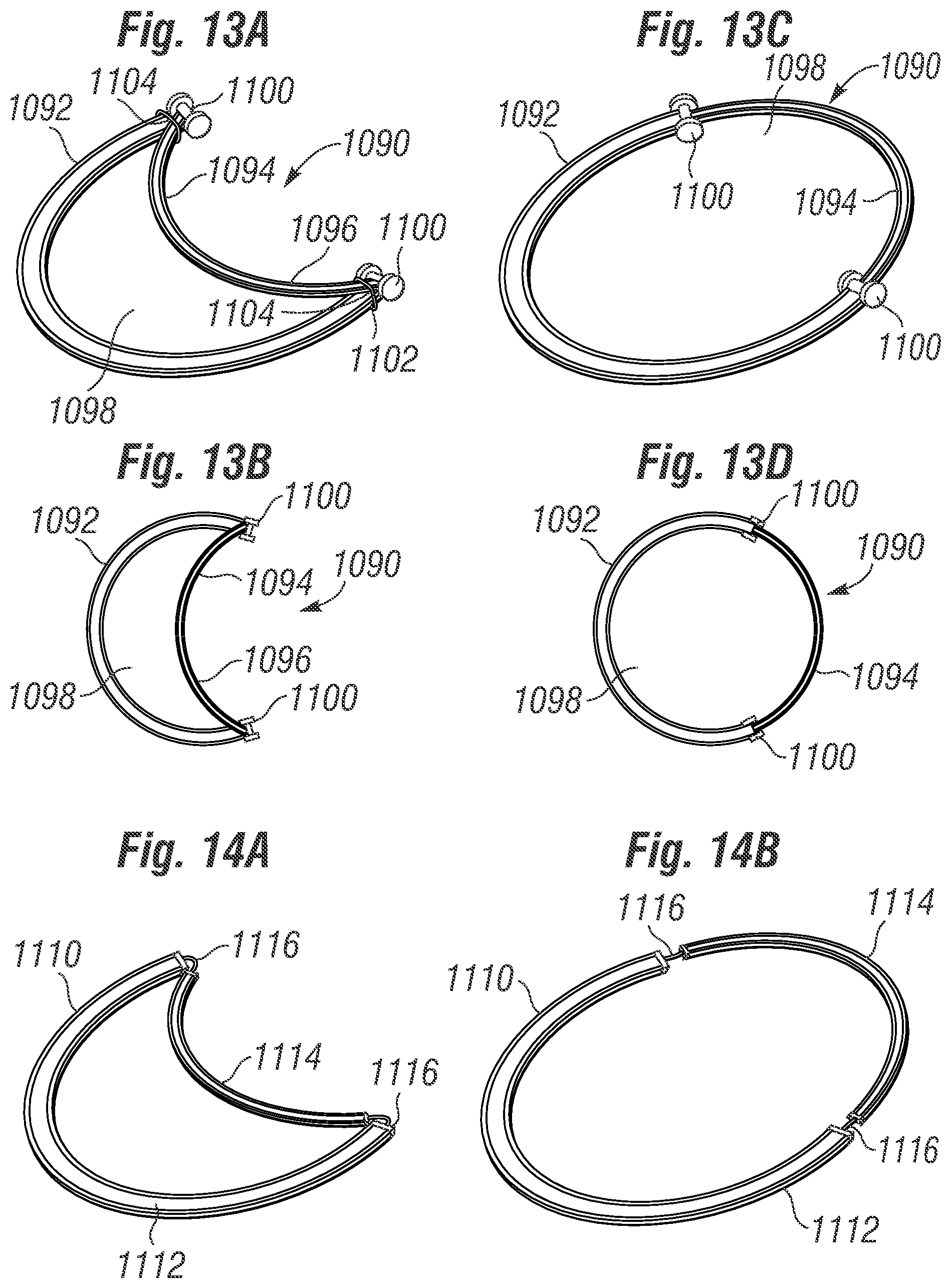 Patent US12396846 Figure 12 – Methods of implanting a prosthetic heart valve within another