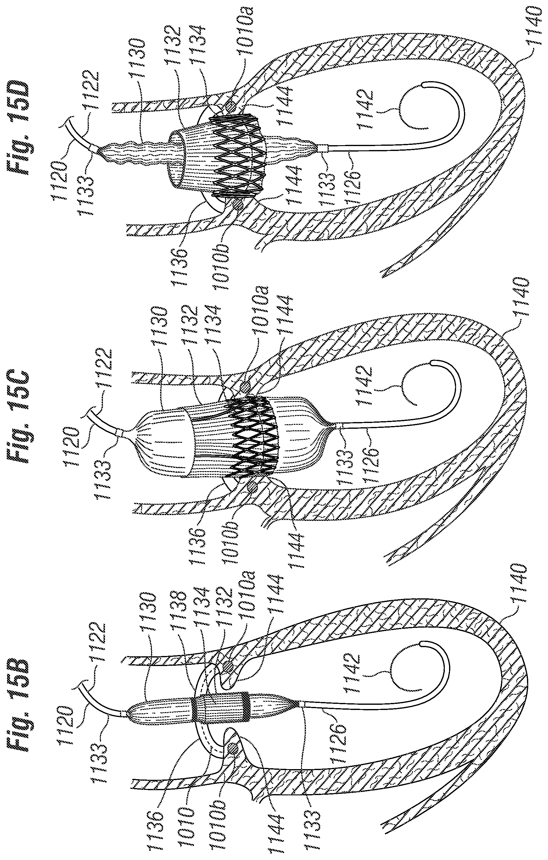 Patent US12396846 Figure 14 – Methods of implanting a prosthetic heart valve within another