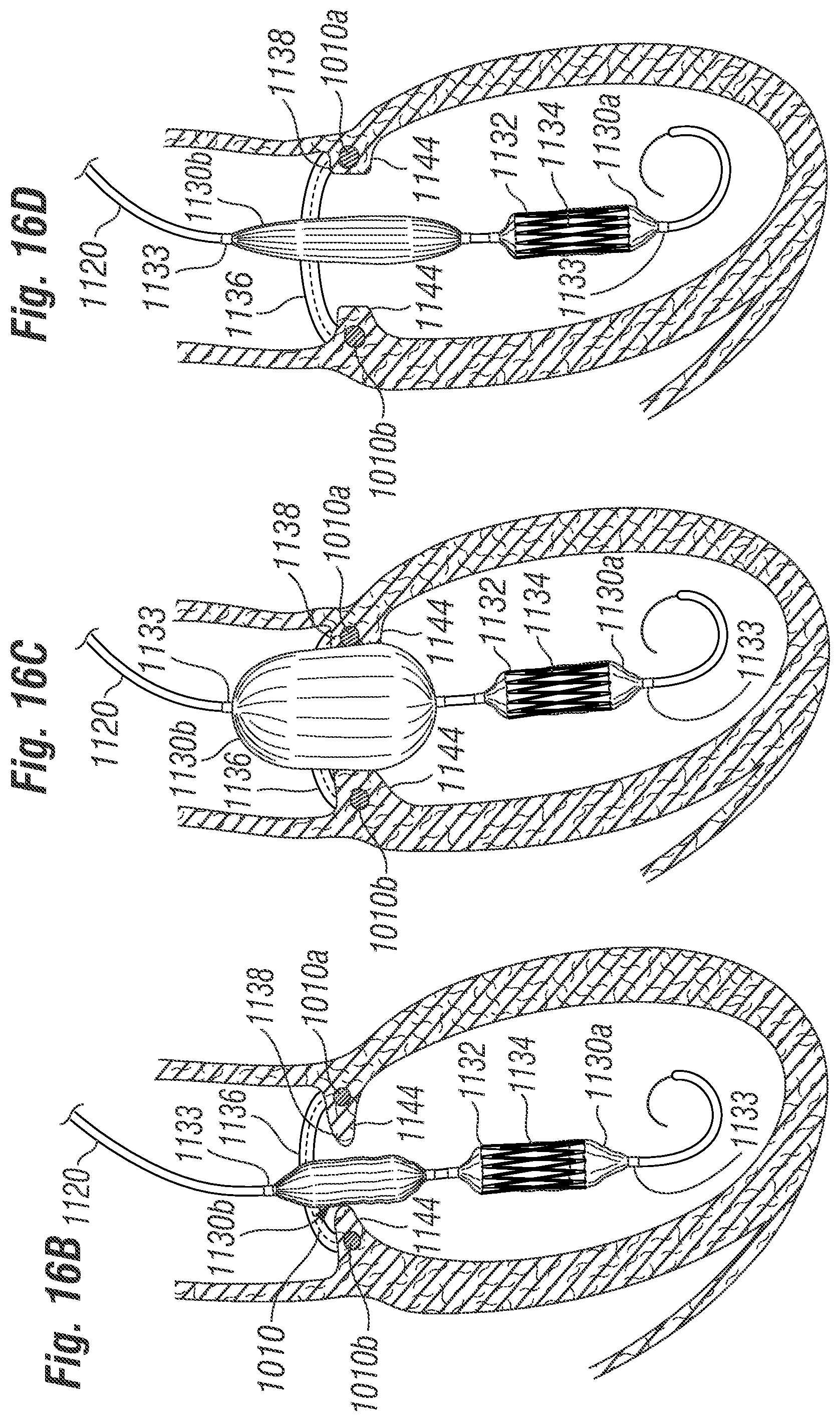 Patent US12396846 Figure 15 – Methods of implanting a prosthetic heart valve within another