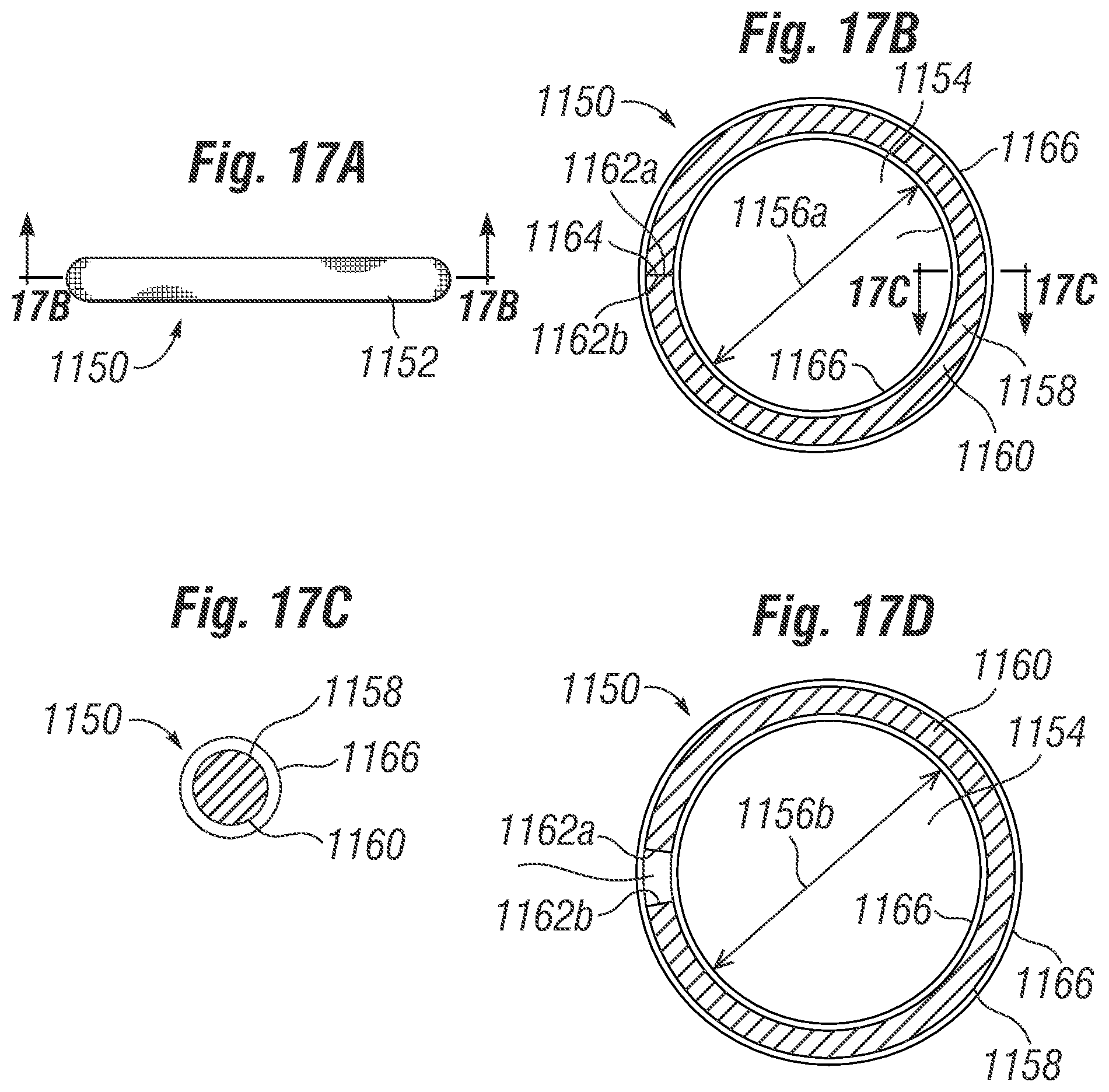 Patent US12396846 Figure 16 – Methods of implanting a prosthetic heart valve within another