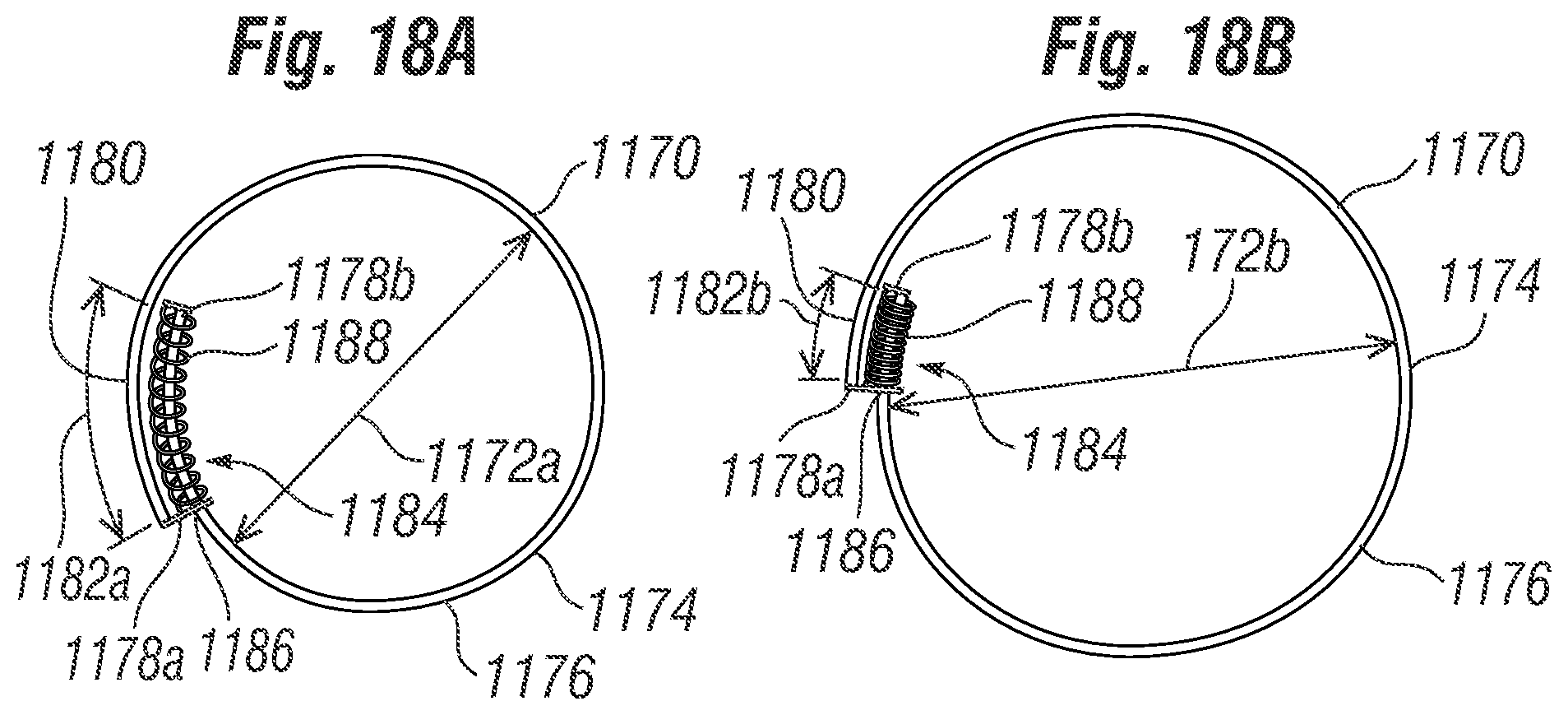 Patent US12396846 Figure 17 – Methods of implanting a prosthetic heart valve within another