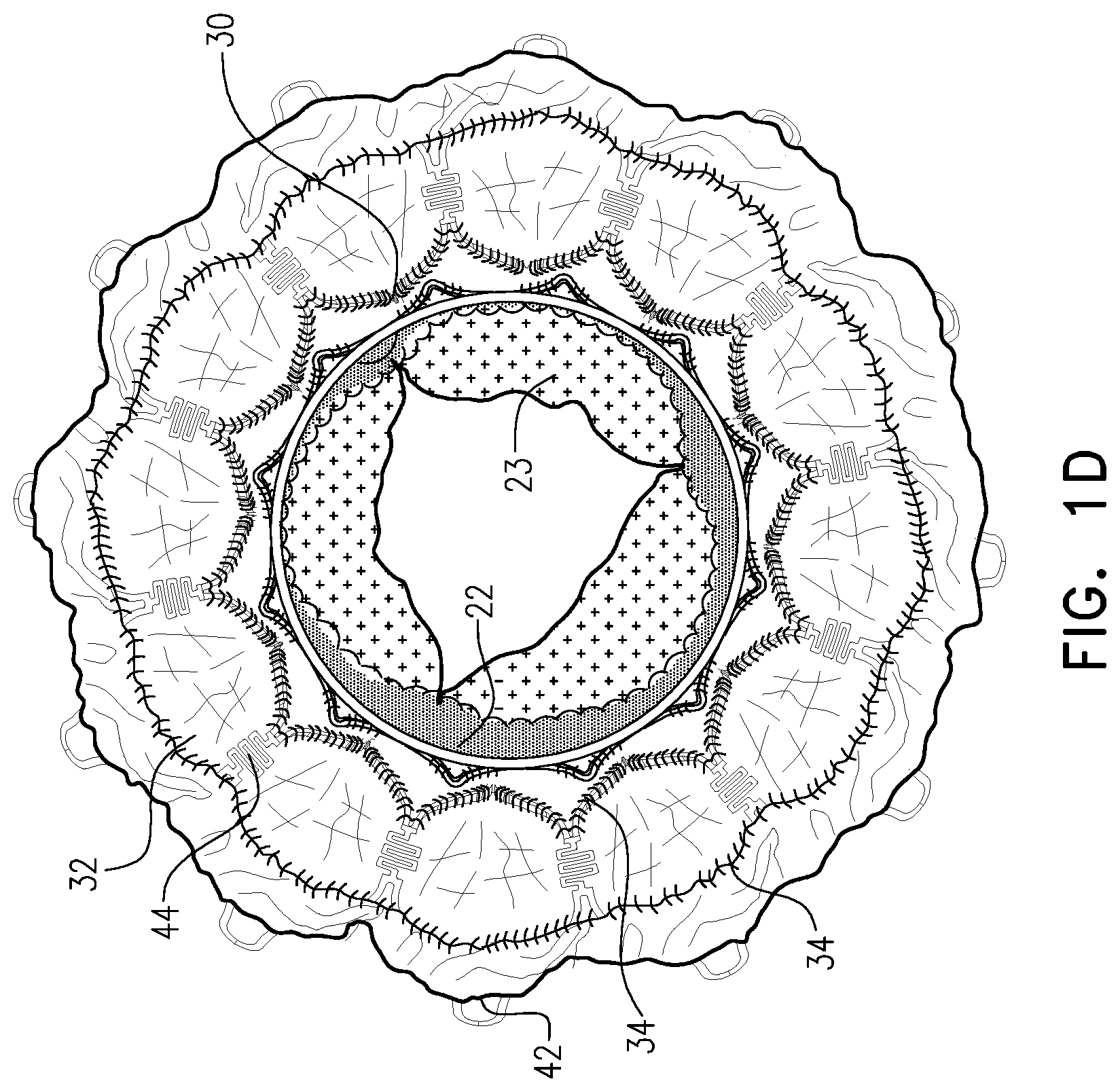 Patent US12396847 Figure 3 – Atrioventricular valve replacement