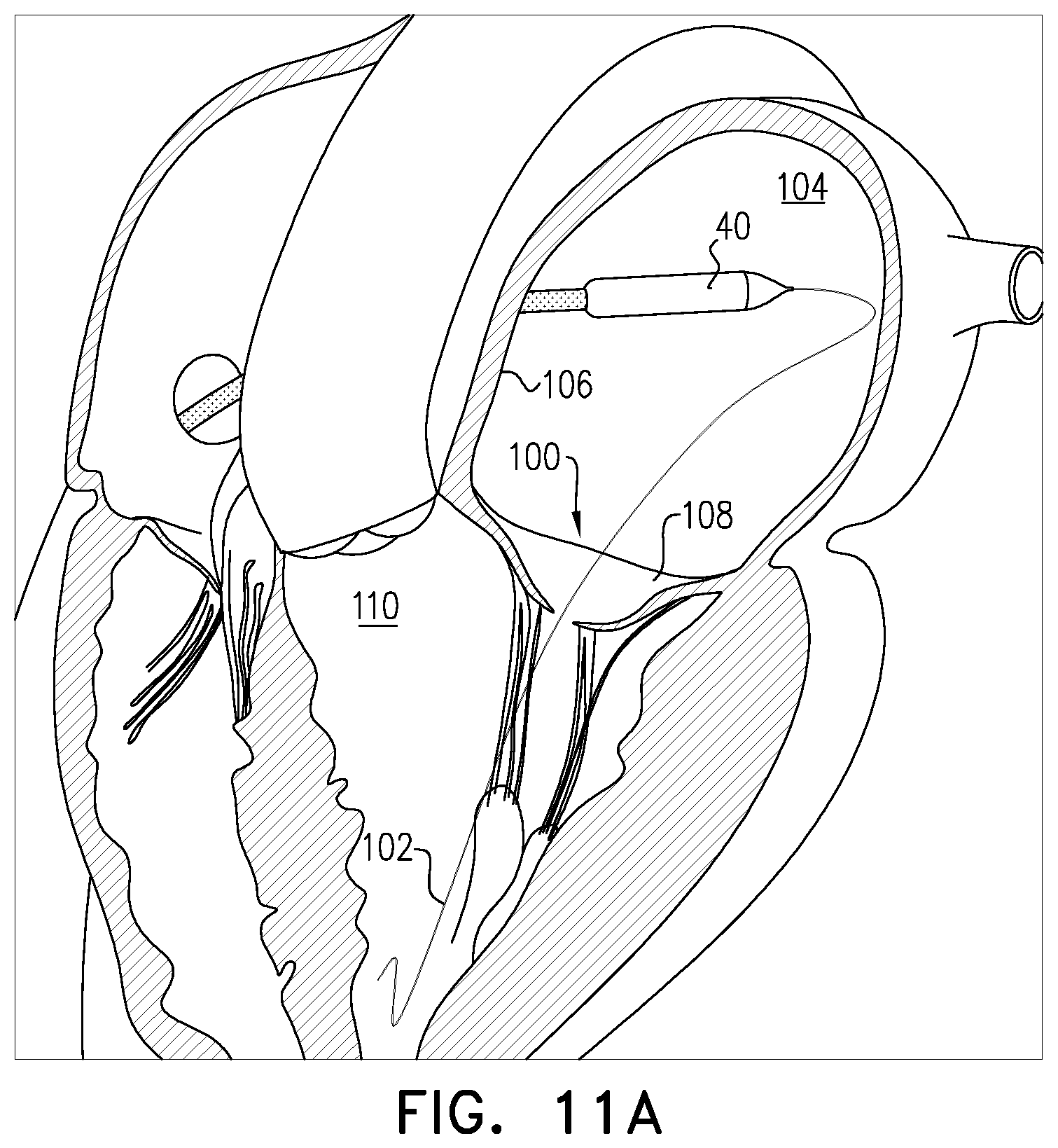 Patent US12396847 Figure 14 – Atrioventricular valve replacement