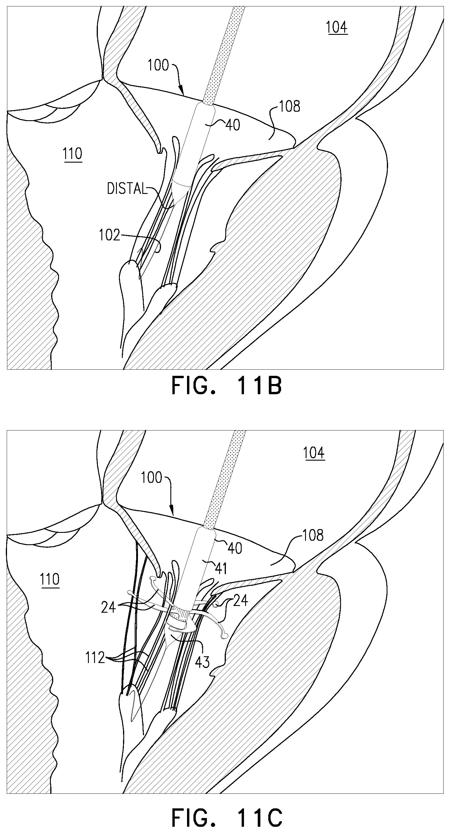 Patent US12396847 Figure 15 – Atrioventricular valve replacement