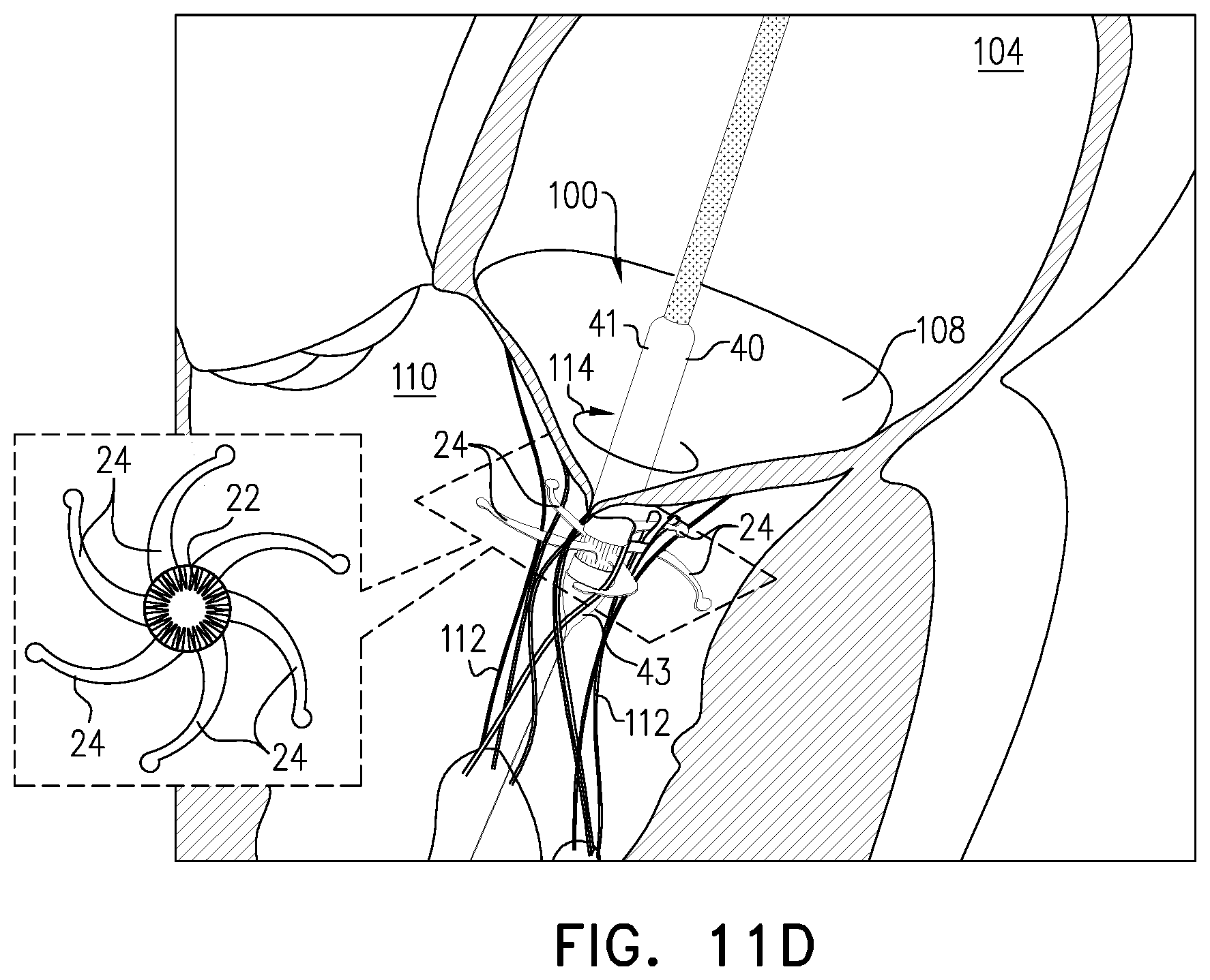 Patent US12396847 Figure 16 – Atrioventricular valve replacement