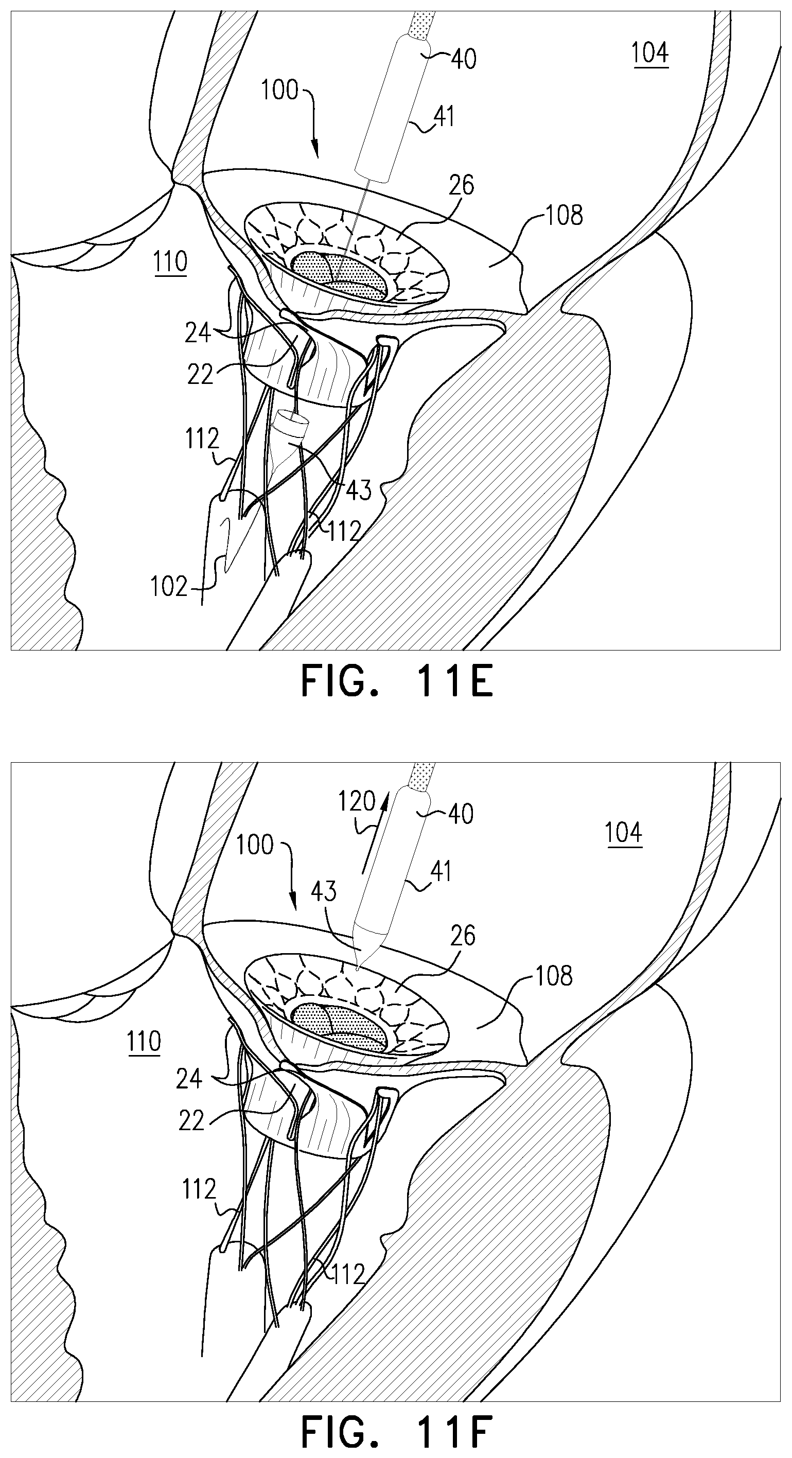 Patent US12396847 Figure 17 – Atrioventricular valve replacement