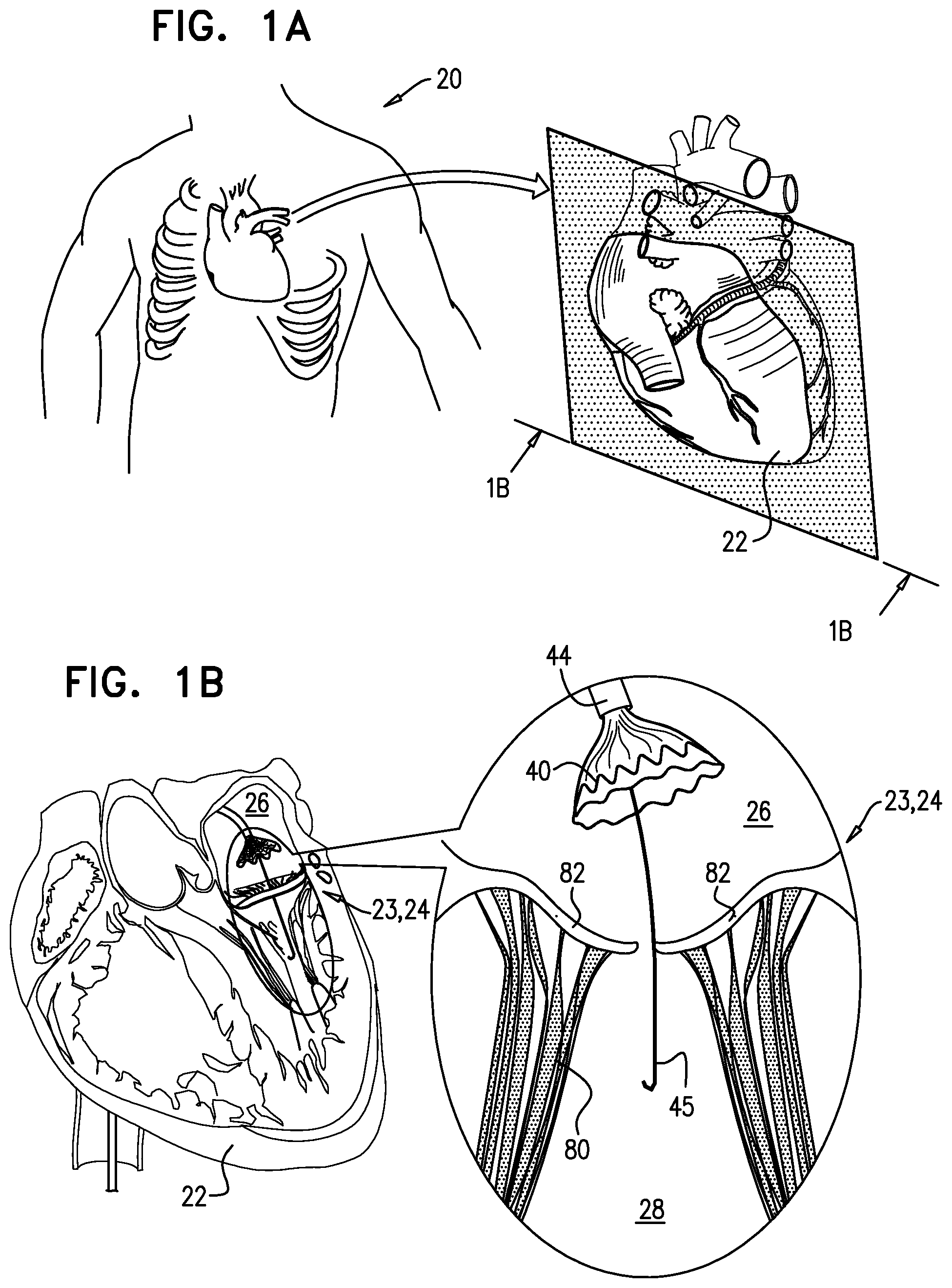 Patent US12396848 — Method for use at a heart valve — Figure 1