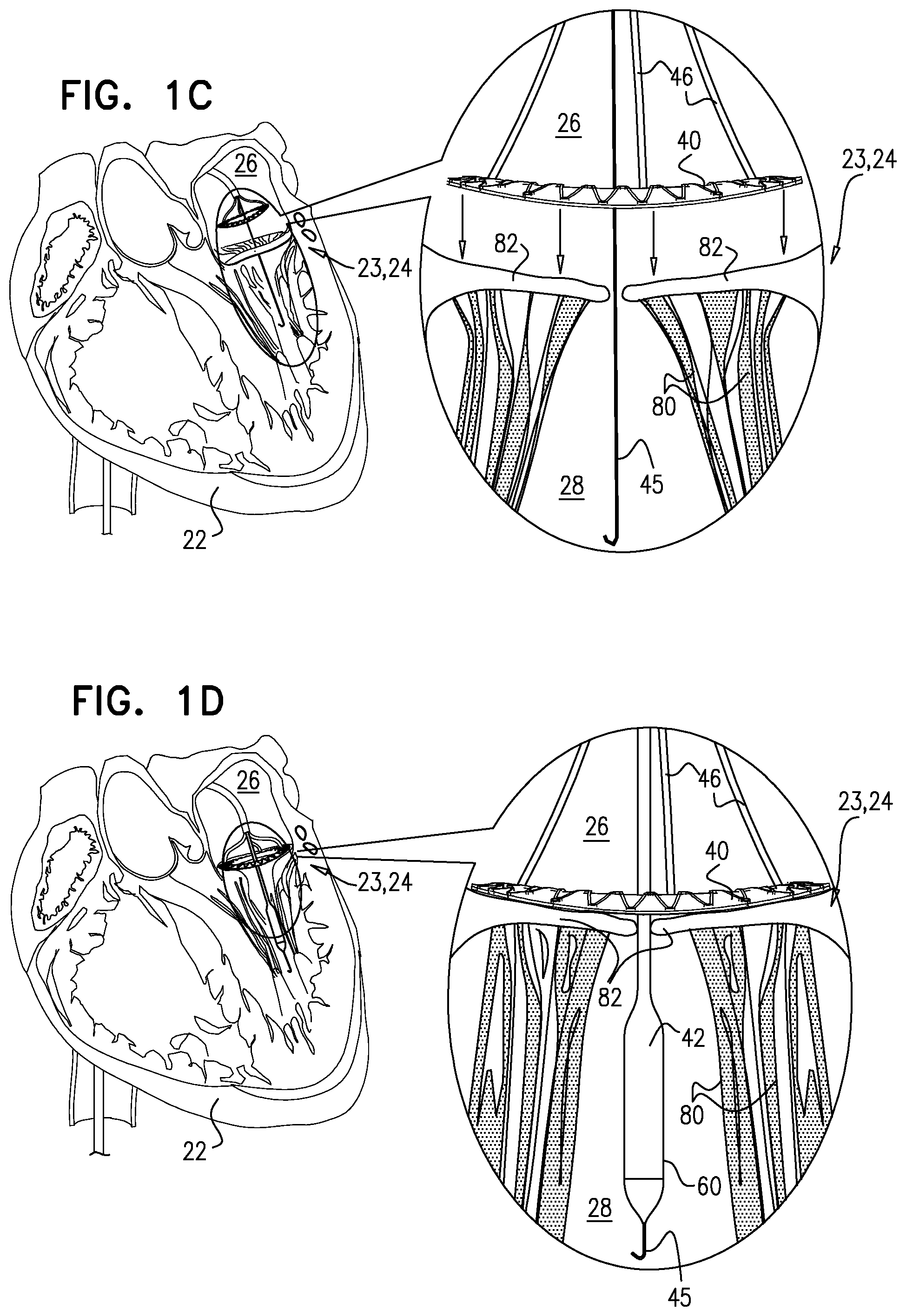 Patent US12396848 Figure 2 – Method for use at a heart valve