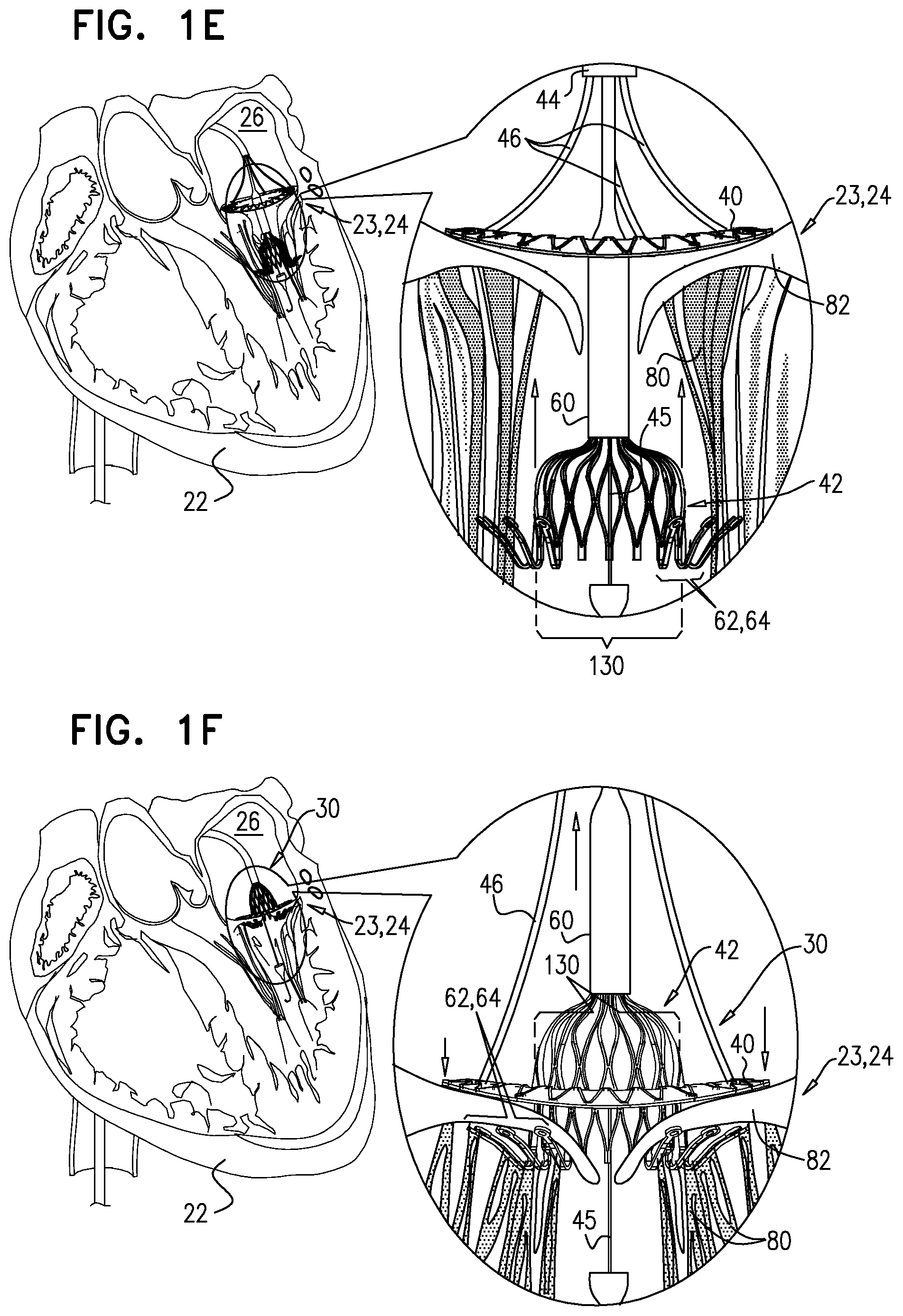 Patent US12396848 Figure 3 – Method for use at a heart valve