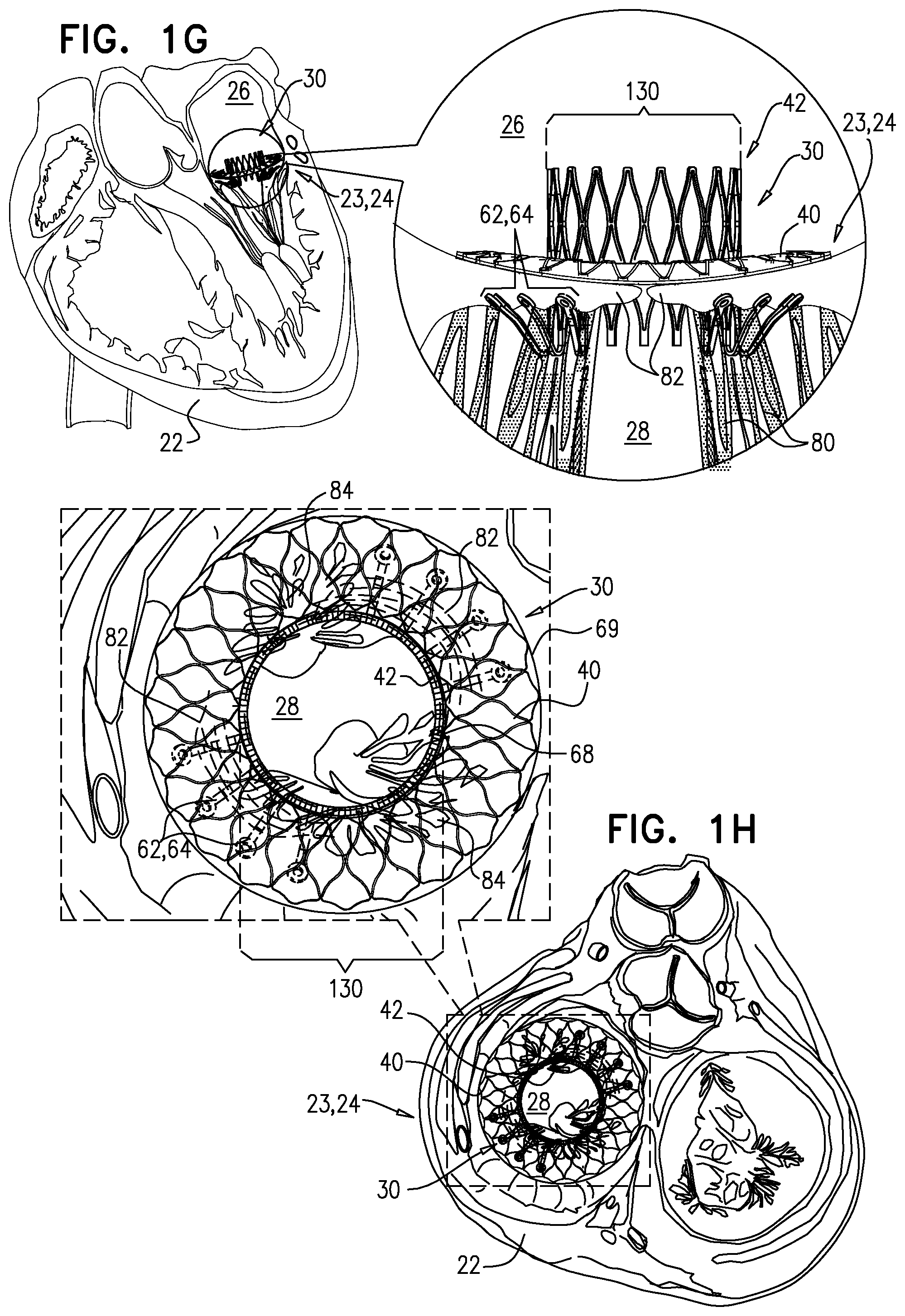 Patent US12396848 Figure 4 – Method for use at a heart valve