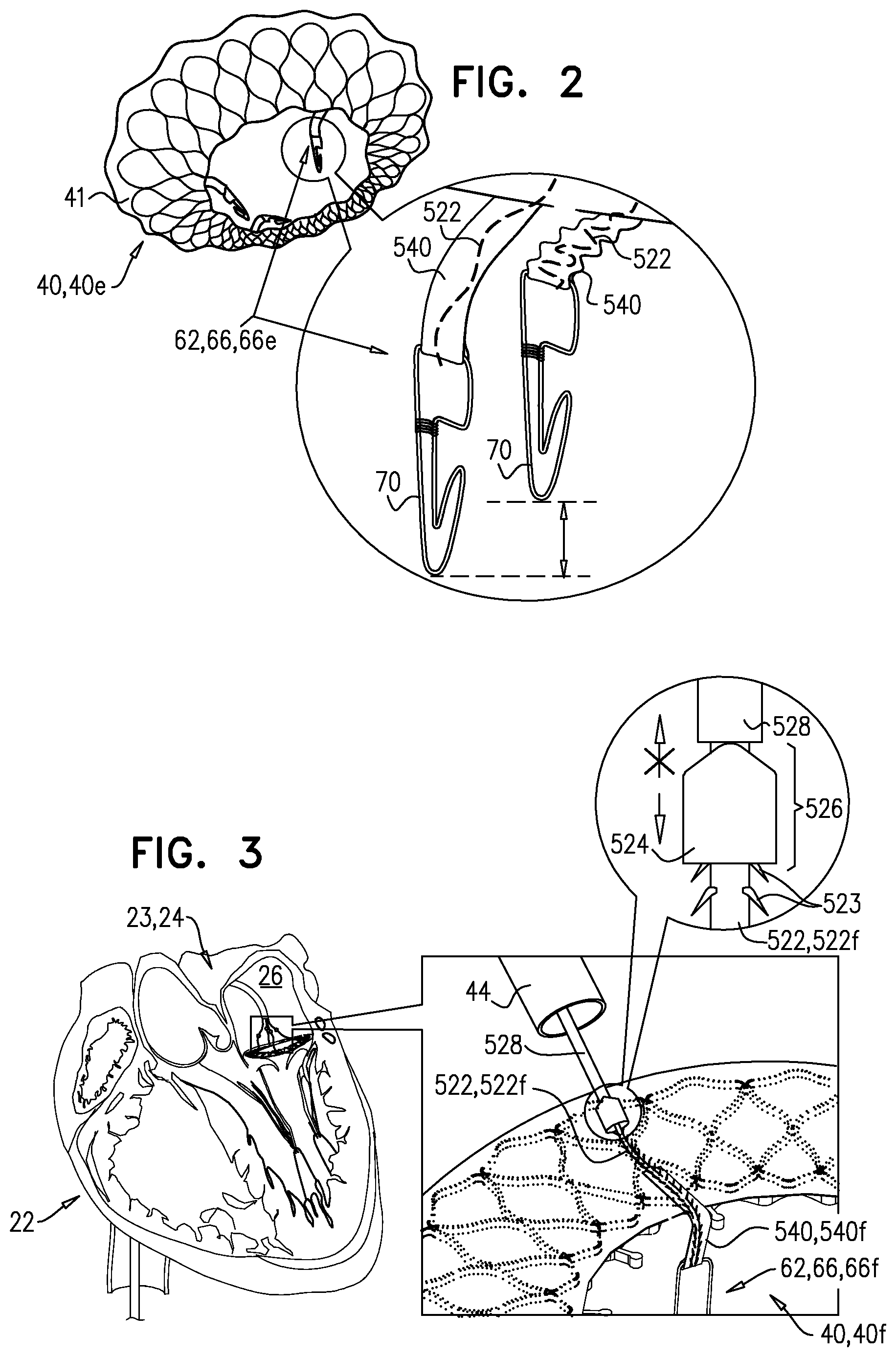 Patent US12396848 Figure 5 – Method for use at a heart valve