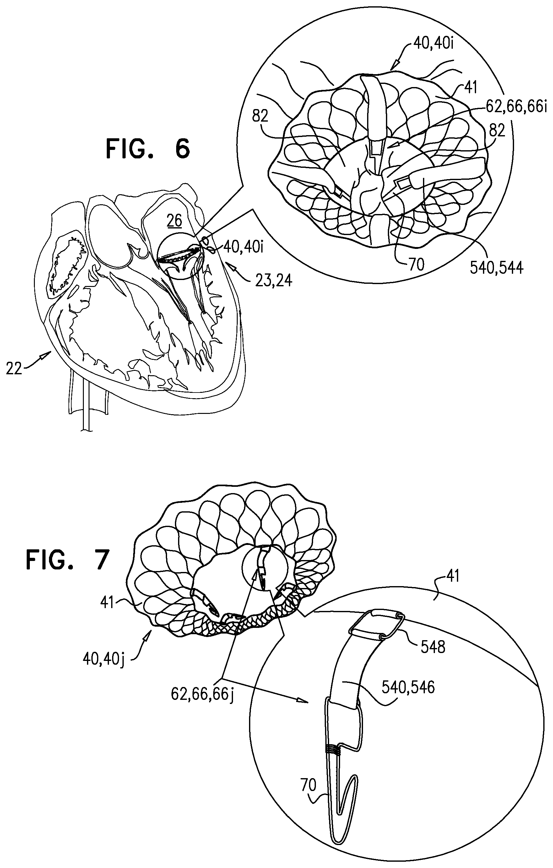 Patent US12396848 Figure 7 – Method for use at a heart valve