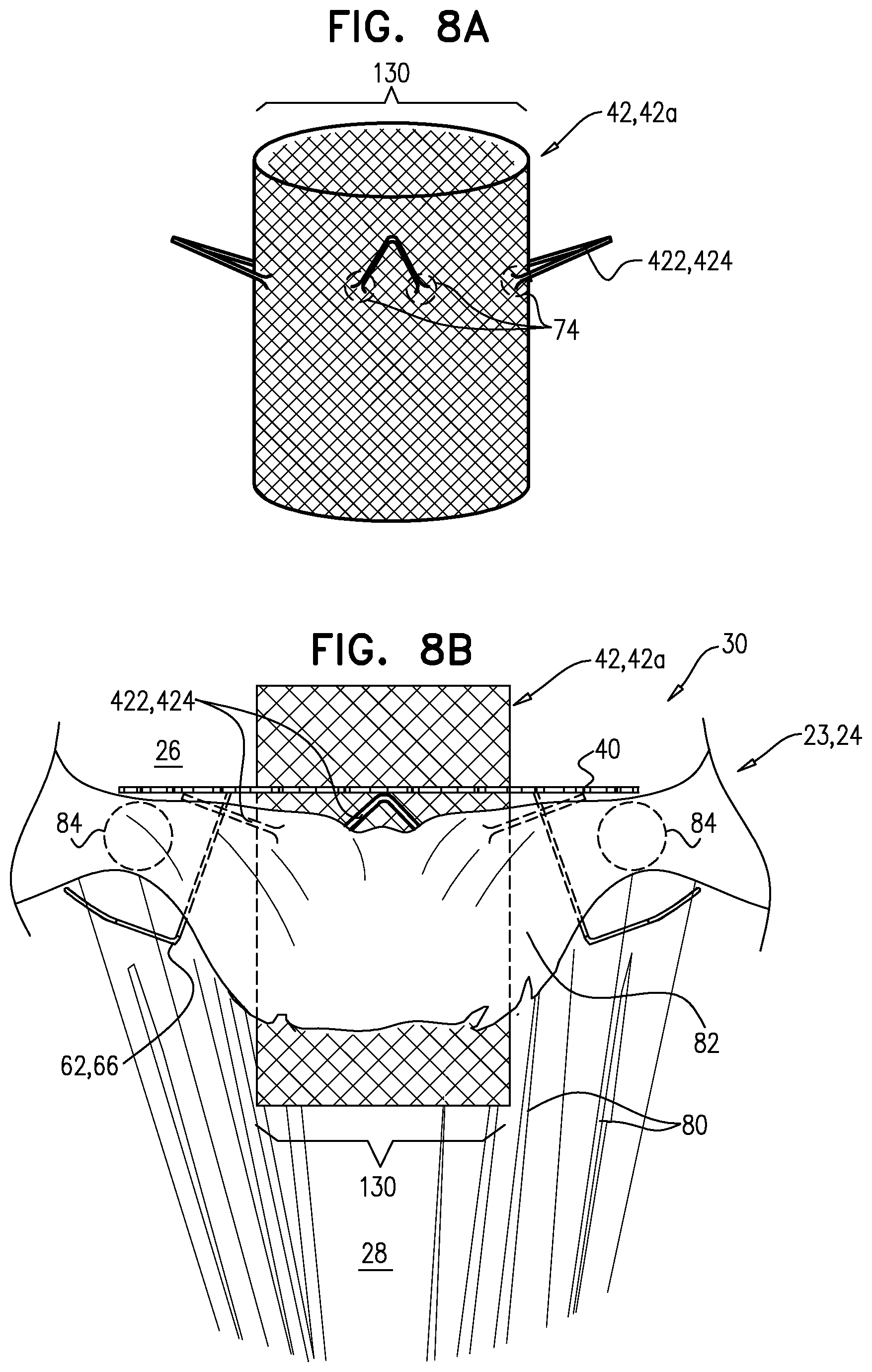 Patent US12396848 Figure 8 – Method for use at a heart valve