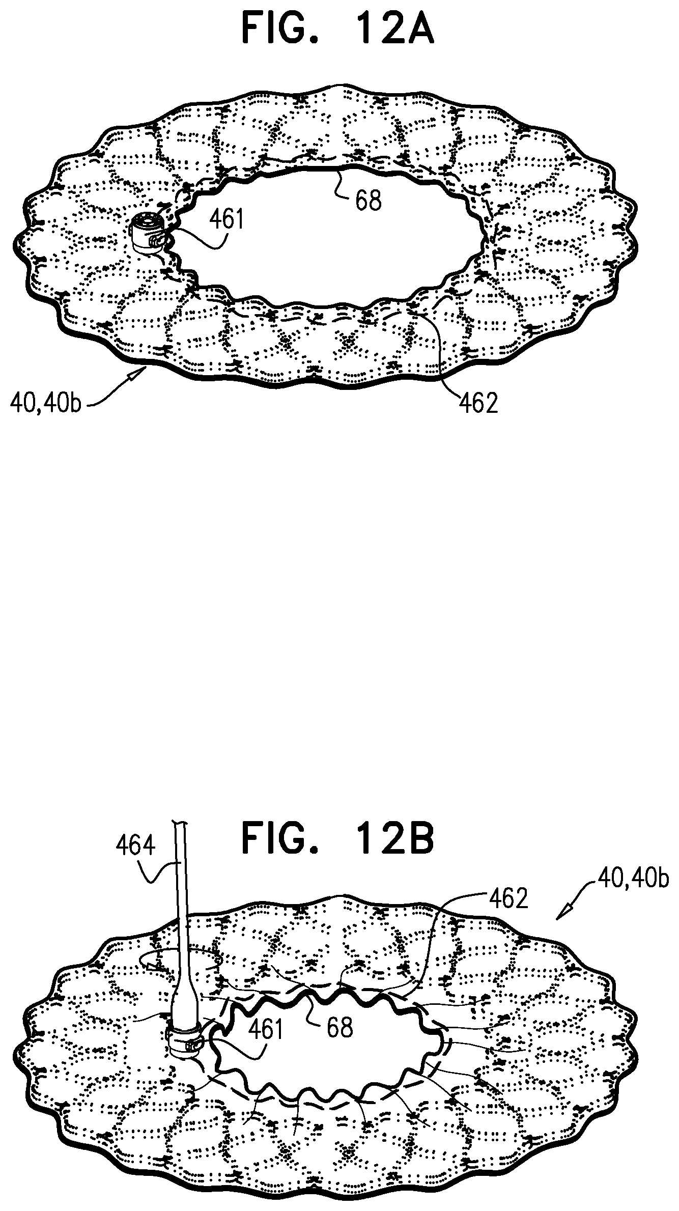 Patent US12396848 Figure 11 – Method for use at a heart valve