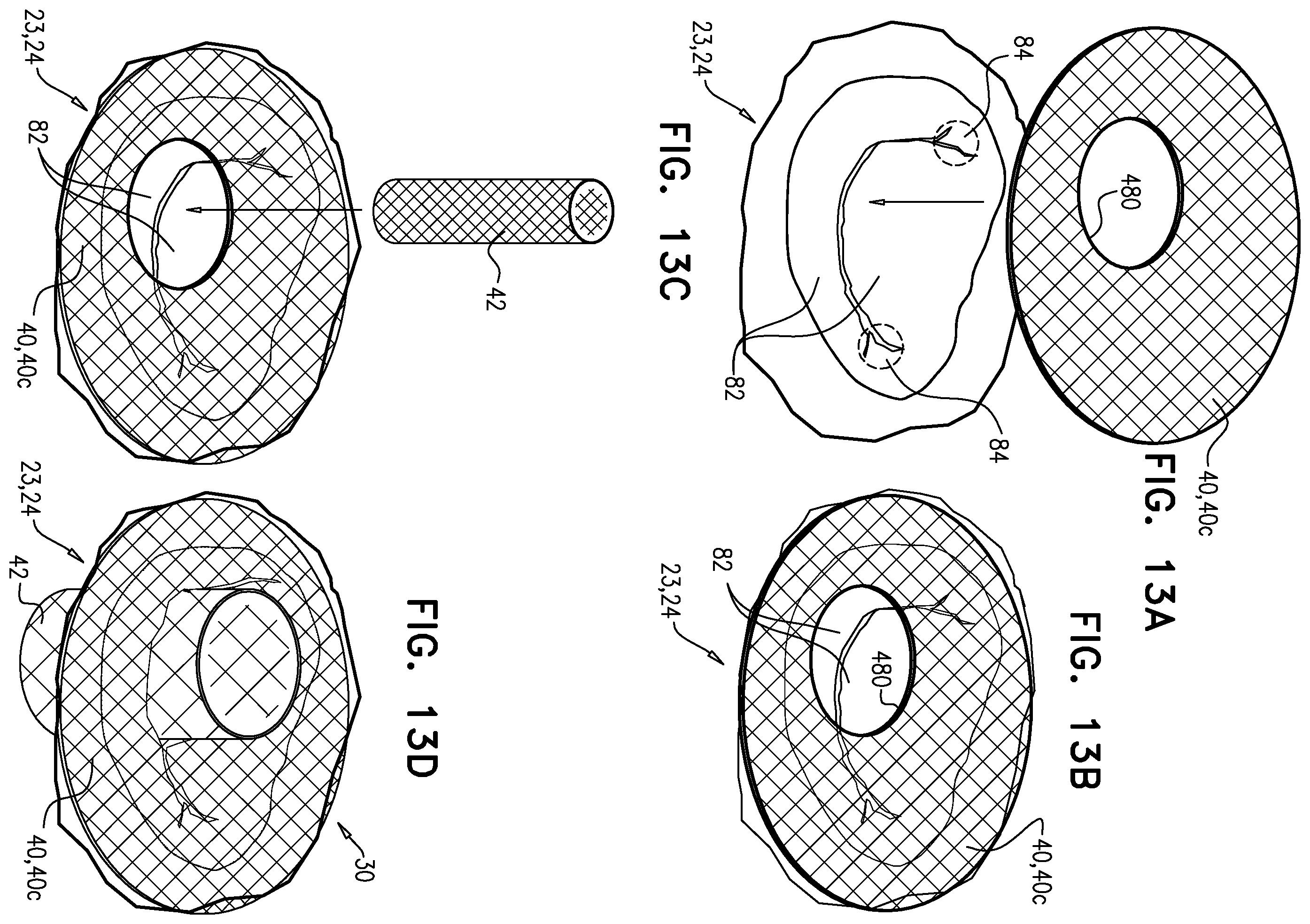Patent US12396848 Figure 12 – Method for use at a heart valve