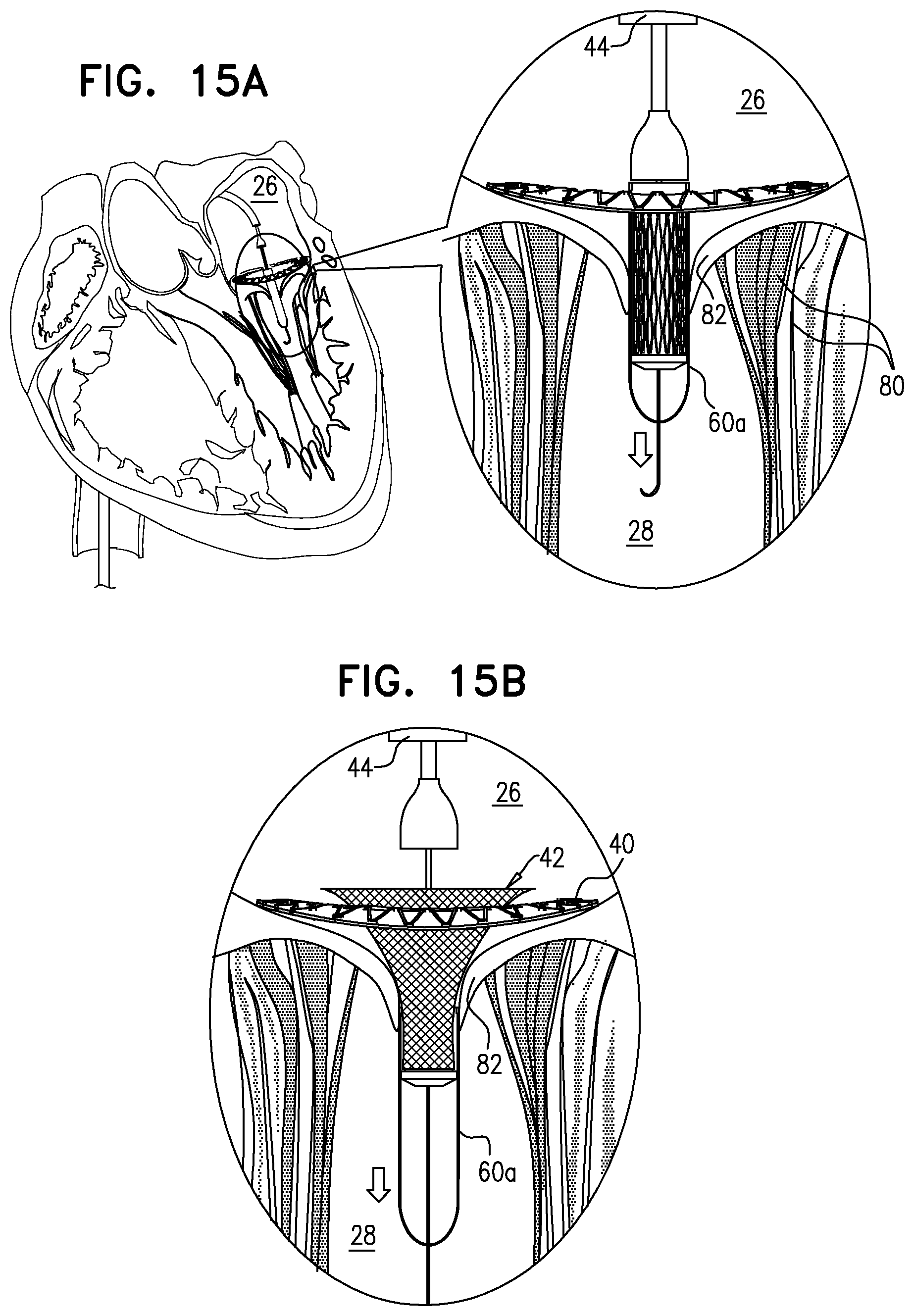 Patent US12396848 Figure 14 – Method for use at a heart valve