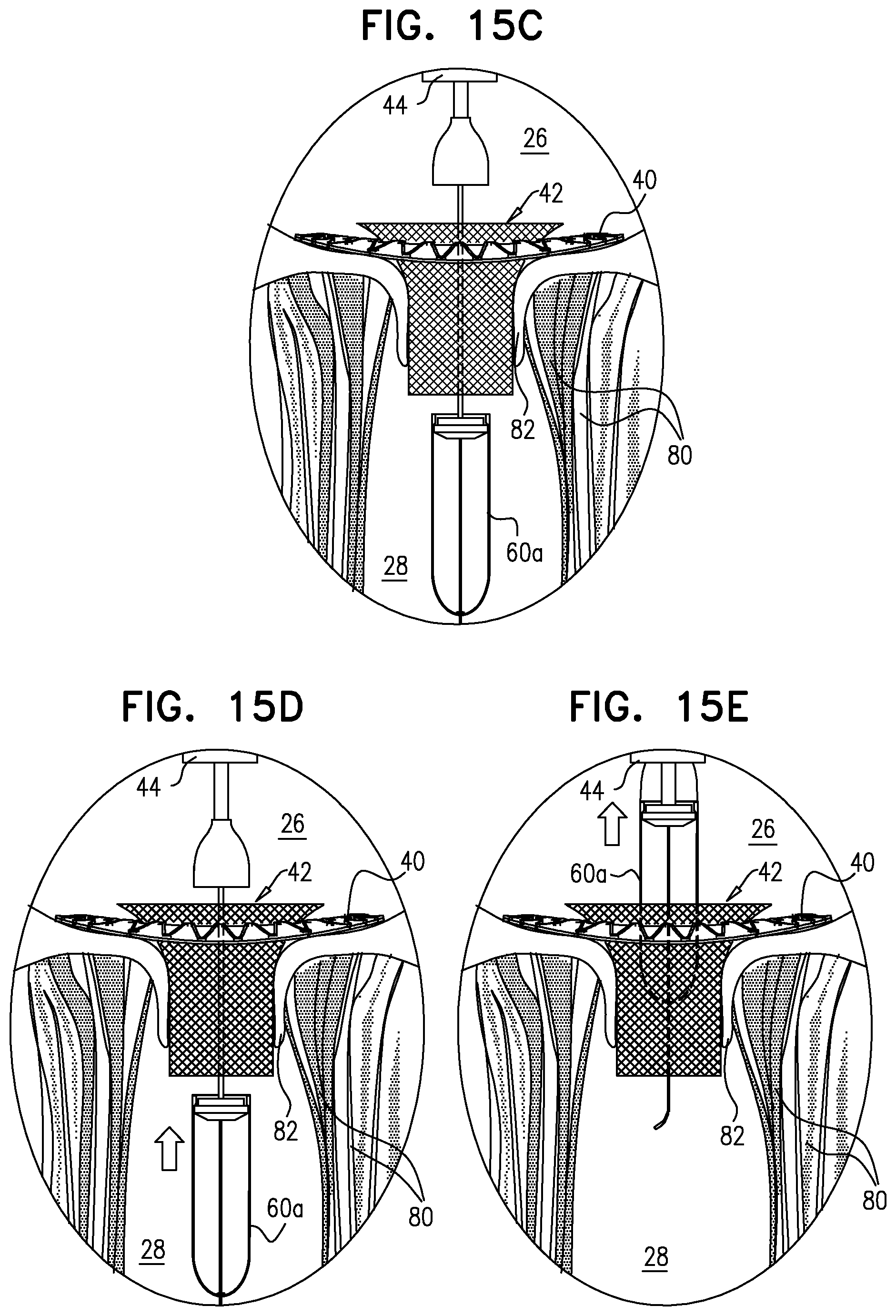 Patent US12396848 Figure 15 – Method for use at a heart valve