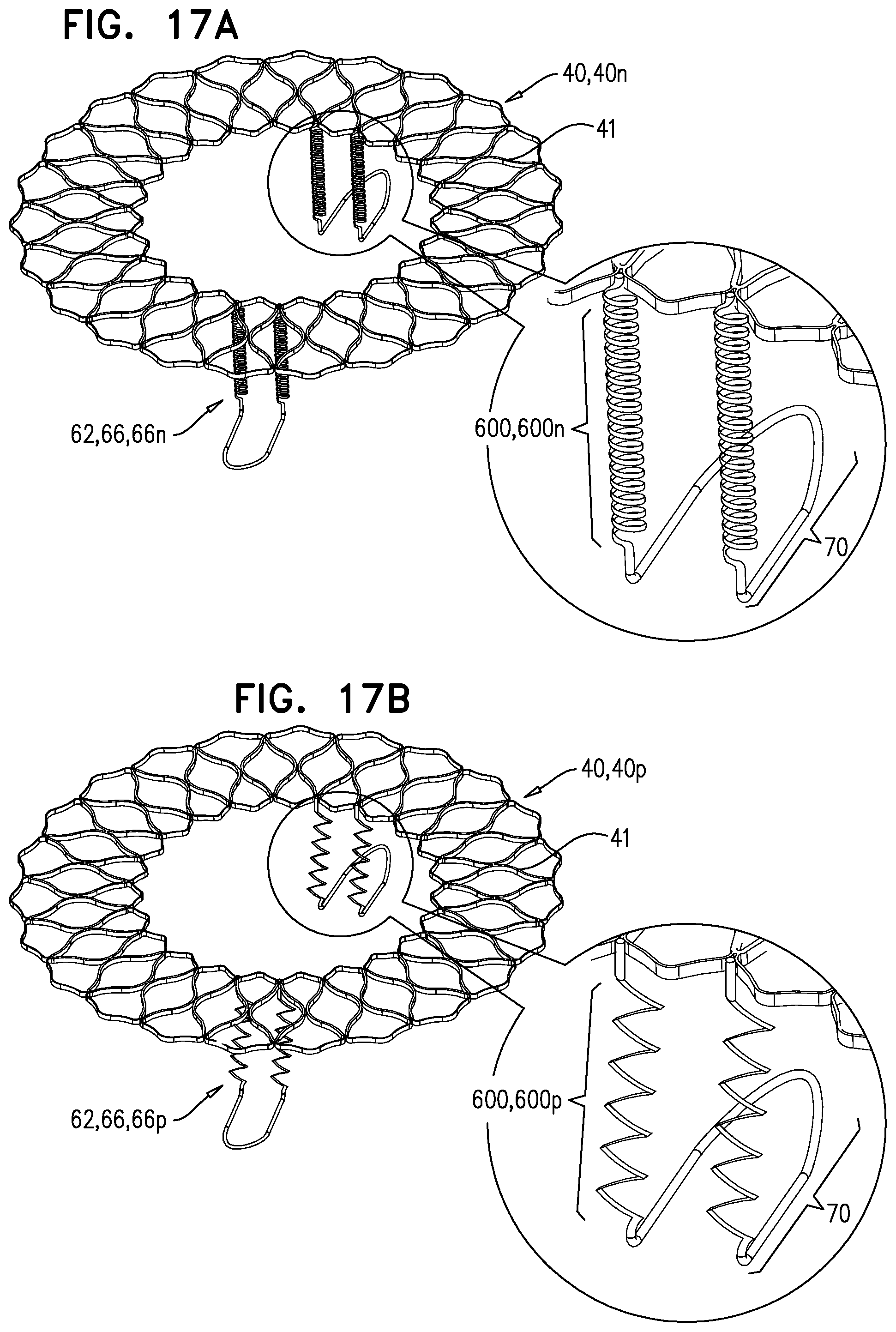 Patent US12396848 Figure 17 – Method for use at a heart valve
