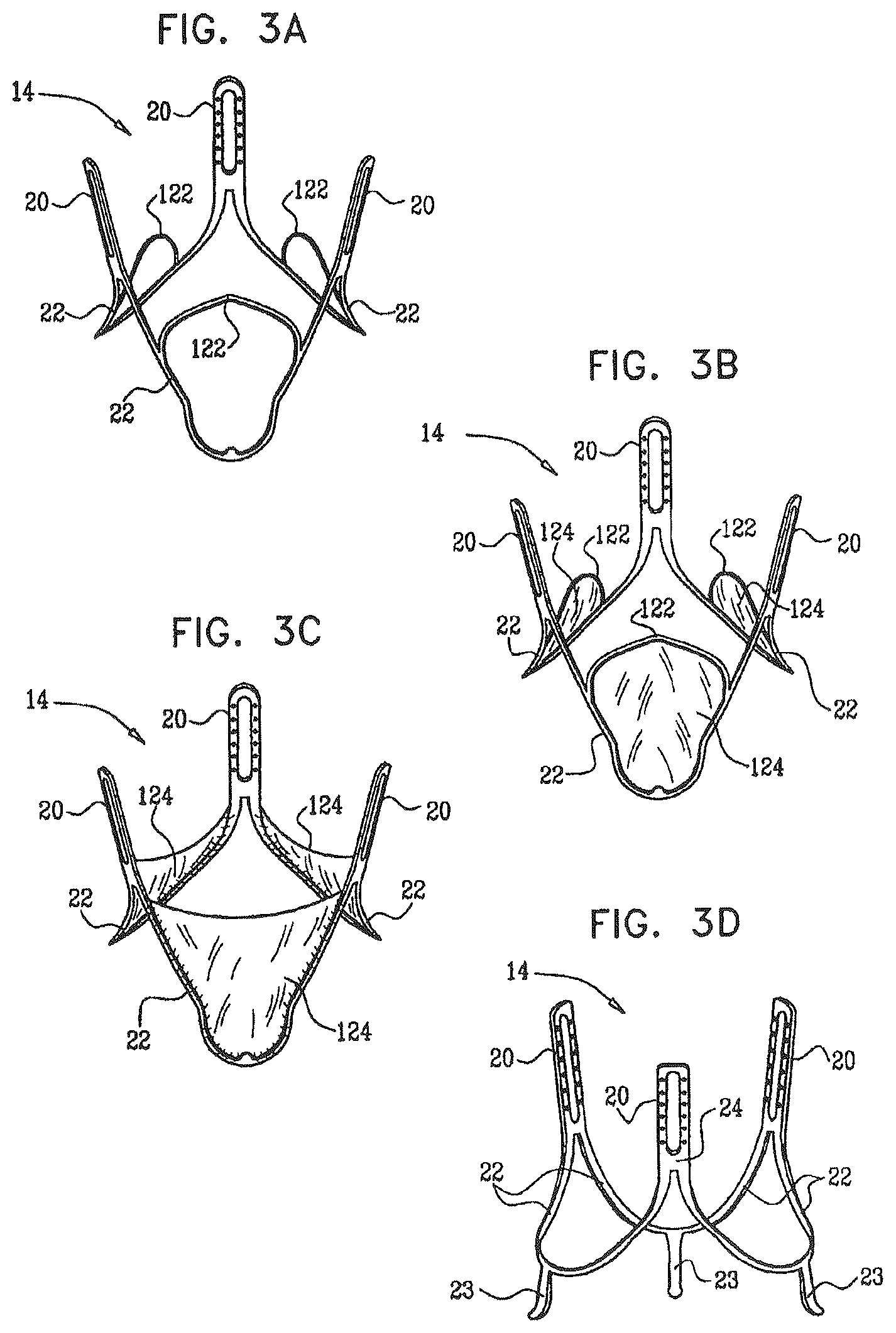 Patent US12396849 Figure 3 – Sinus-engaging valve fixation member