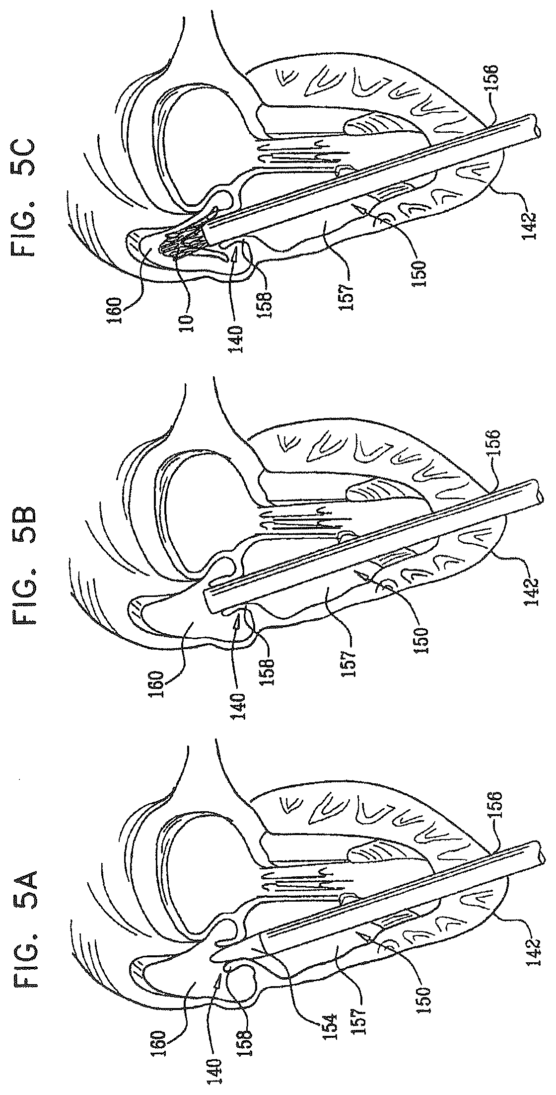 Patent US12396849 Figure 7 – Sinus-engaging valve fixation member