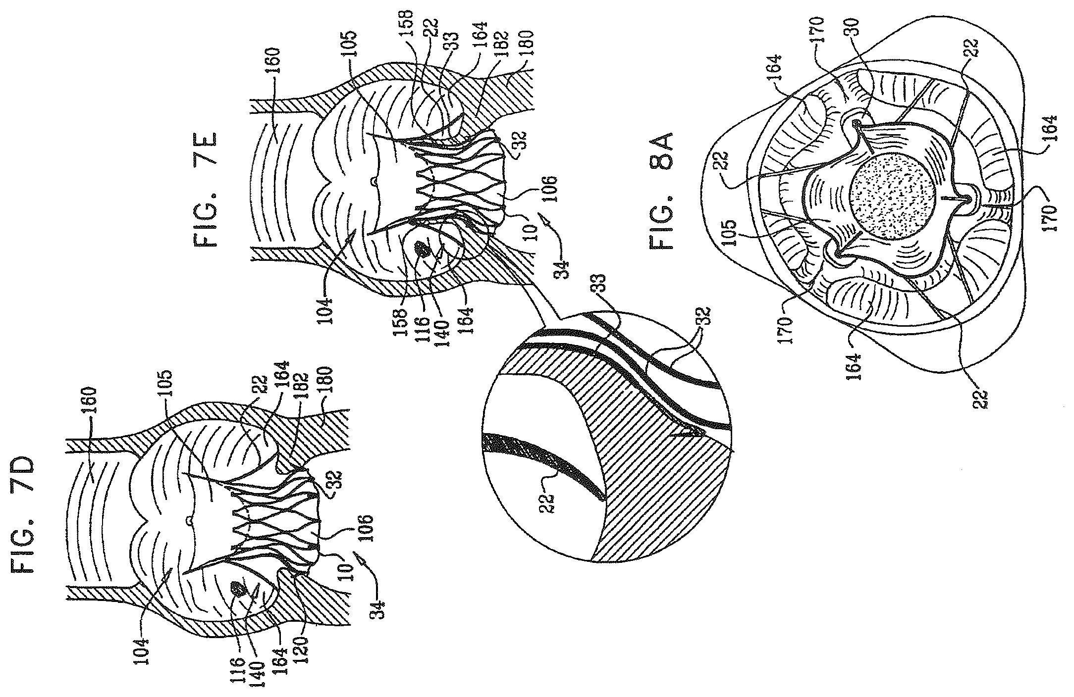 Patent US12396849 Figure 10 – Sinus-engaging valve fixation member