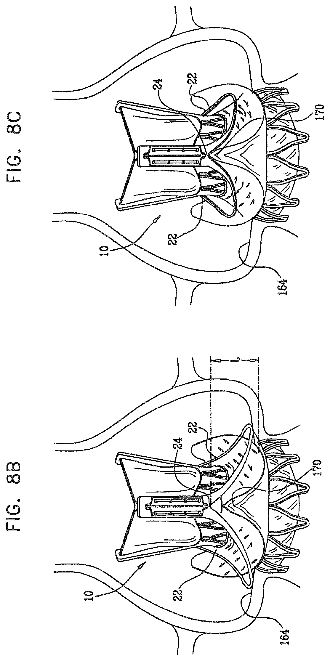 Patent US12396849 Figure 11 – Sinus-engaging valve fixation member