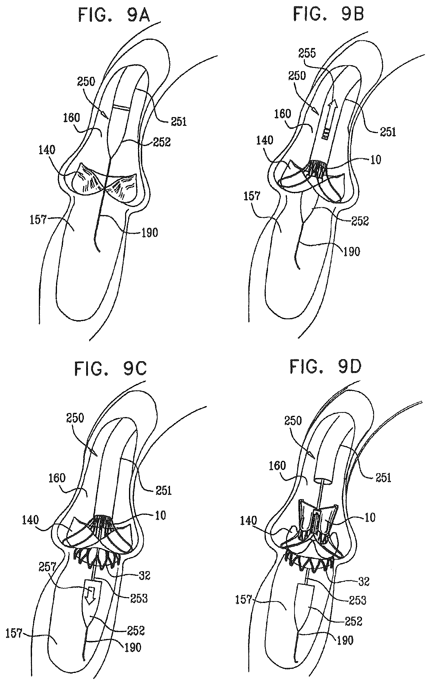 Patent US12396849 Figure 12 – Sinus-engaging valve fixation member