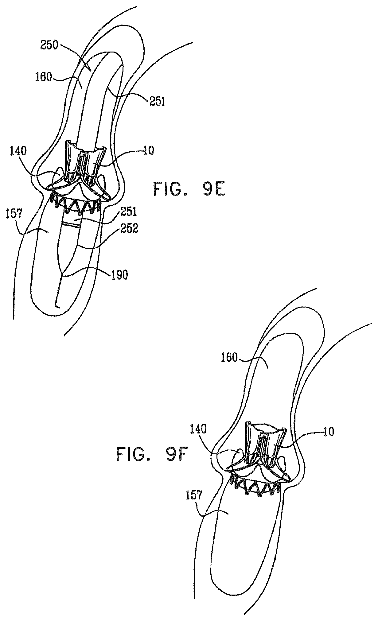 Patent US12396849 Figure 13 – Sinus-engaging valve fixation member