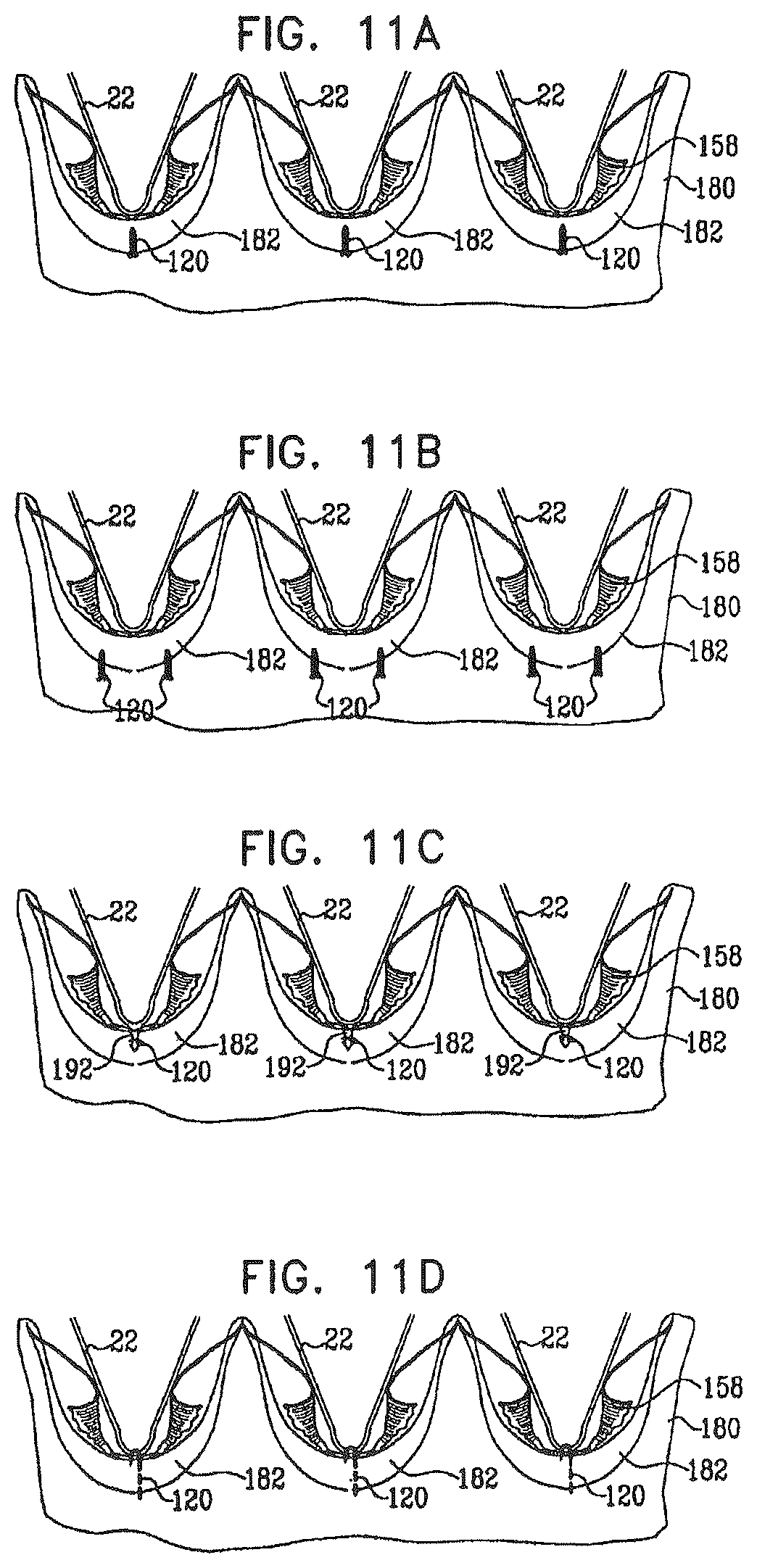 Patent US12396849 Figure 16 – Sinus-engaging valve fixation member