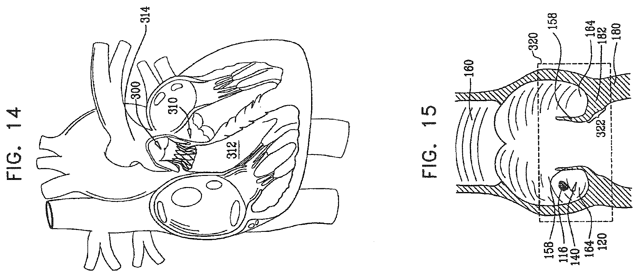 Patent US12396849 Figure 20 – Sinus-engaging valve fixation member