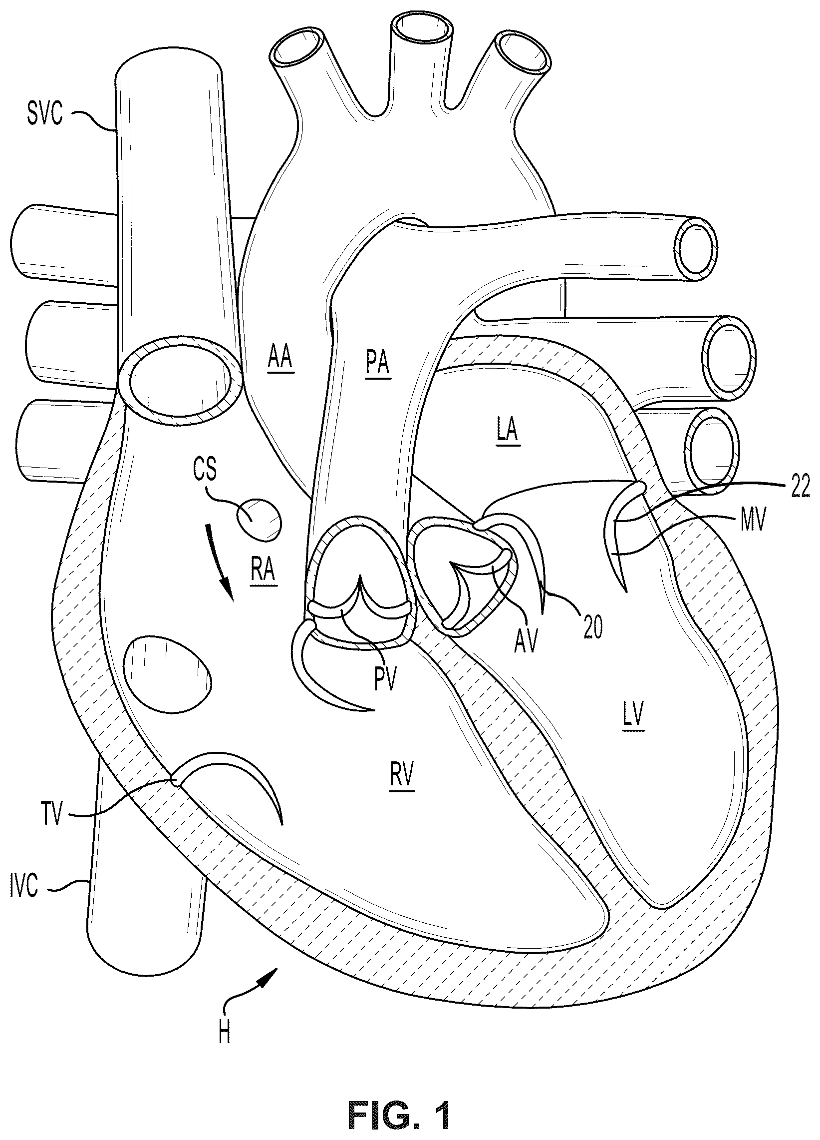 Patent US12396850 Figure 1 – Catheterization method and apparatus