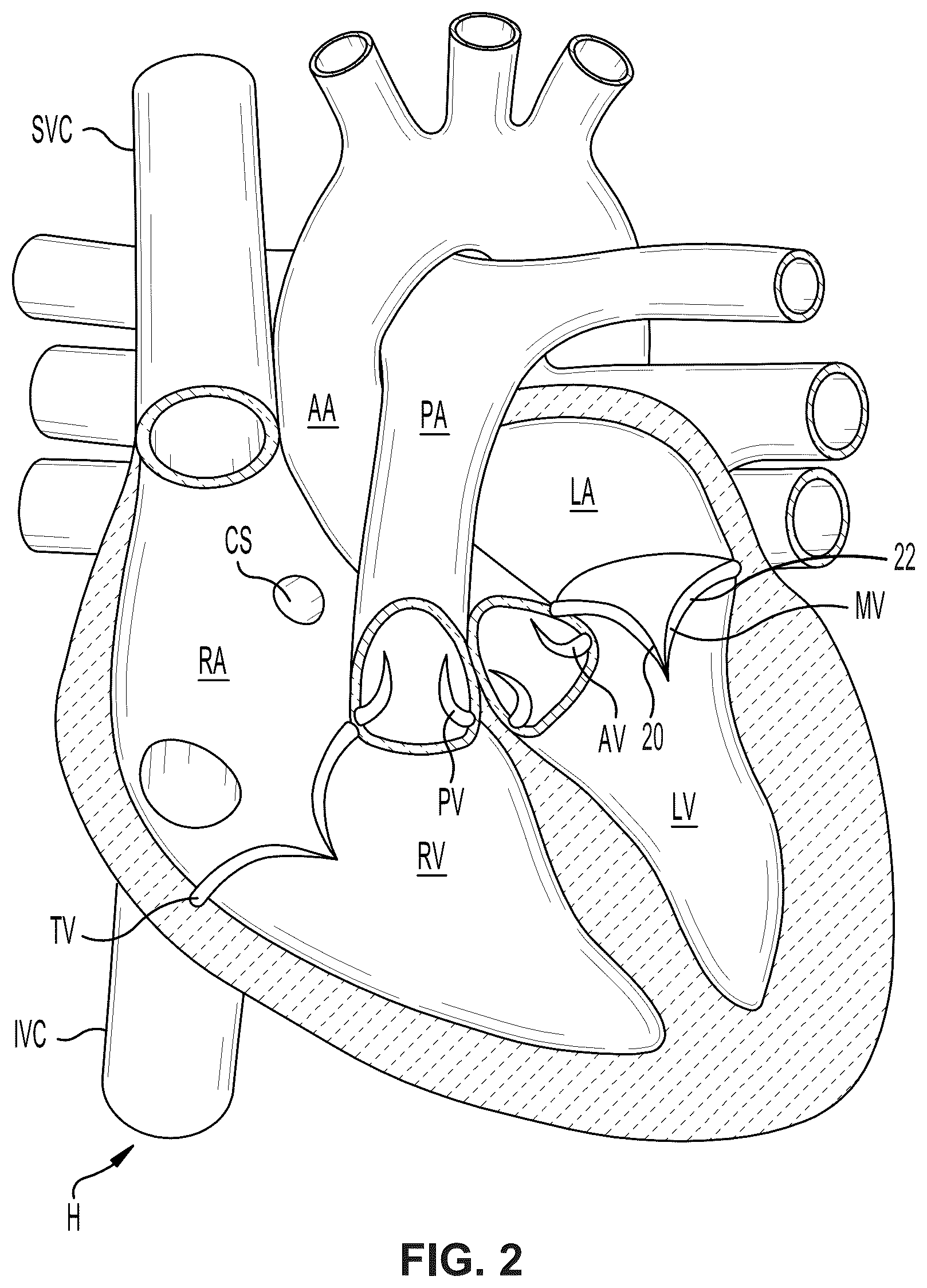 Patent US12396850 Figure 2 – Catheterization method and apparatus