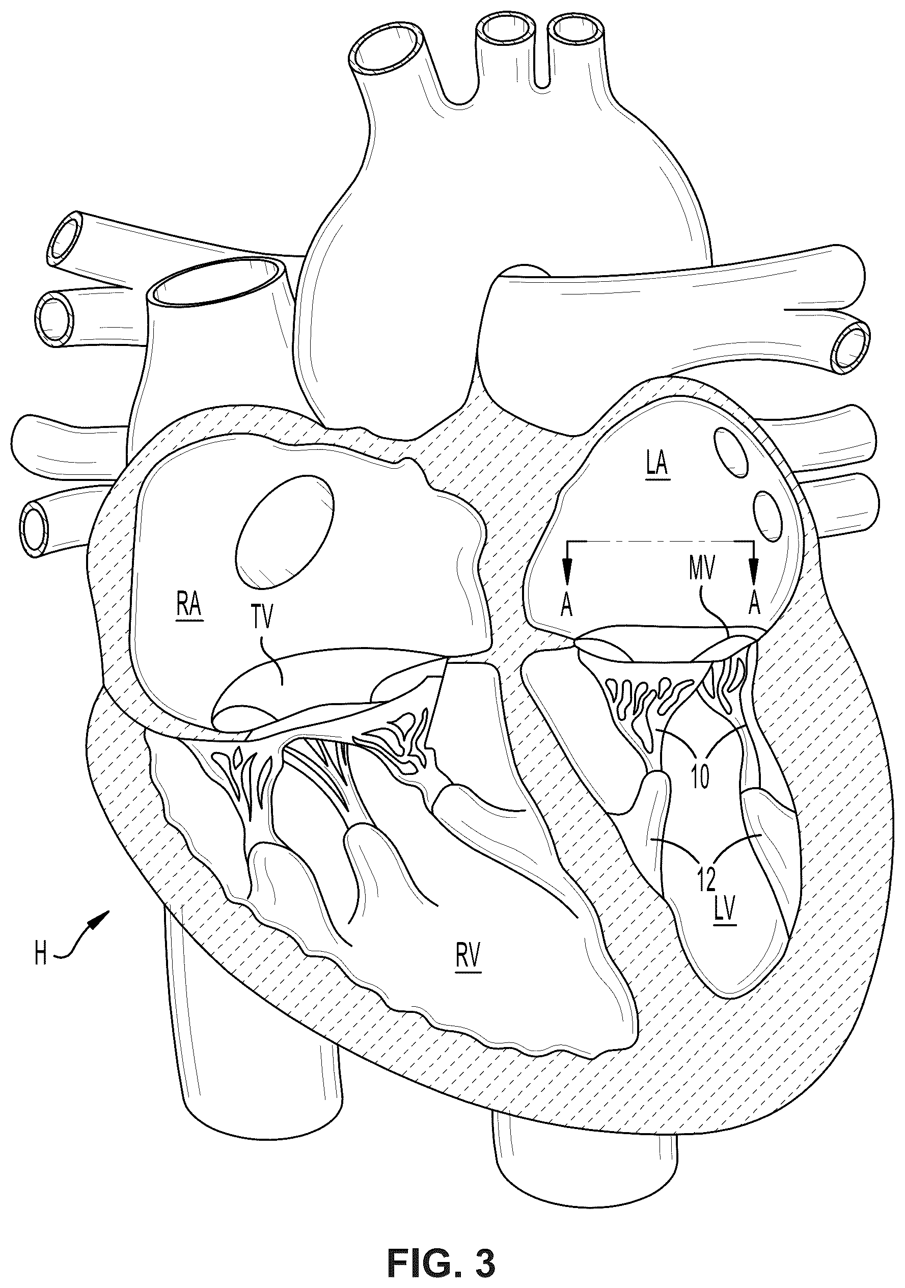 Patent US12396850 Figure 3 – Catheterization method and apparatus