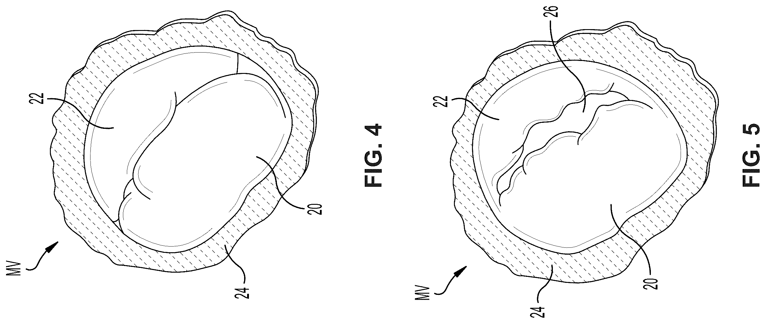 Patent US12396850 Figure 4 – Catheterization method and apparatus