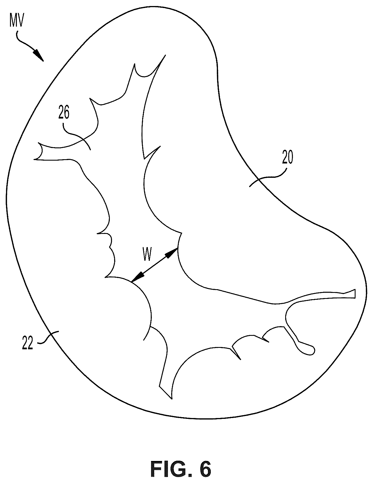 Patent US12396850 Figure 5 – Catheterization method and apparatus