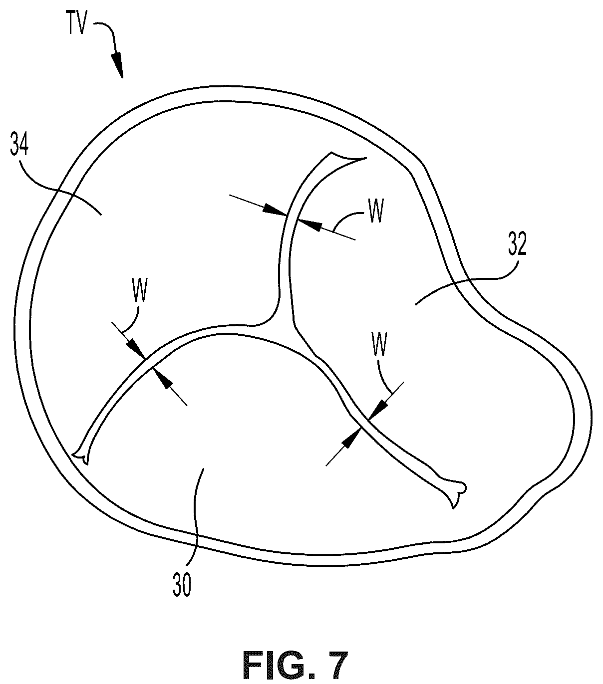 Patent US12396850 Figure 6 – Catheterization method and apparatus