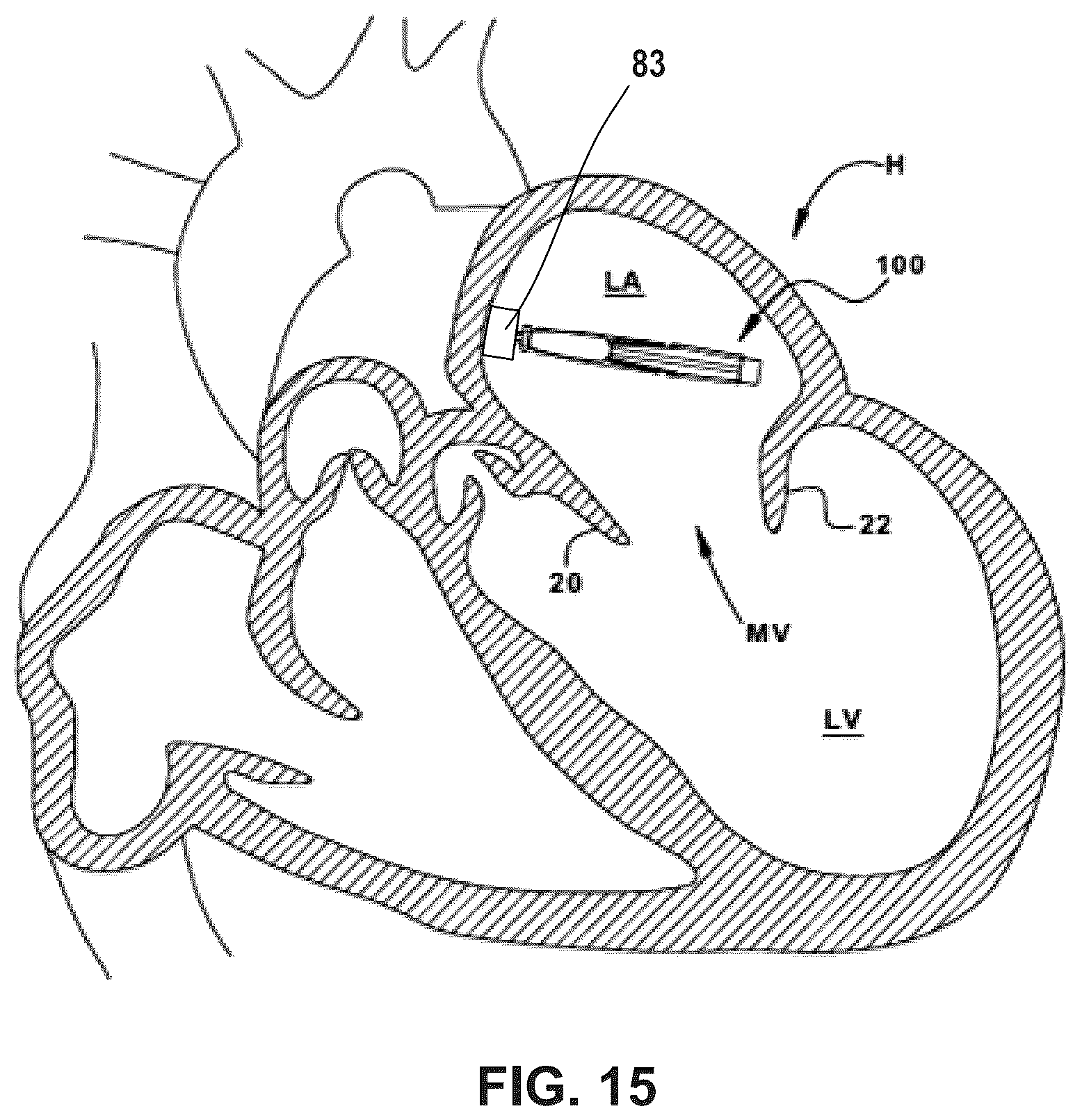 Patent US12396850 Figure 10 – Catheterization method and apparatus